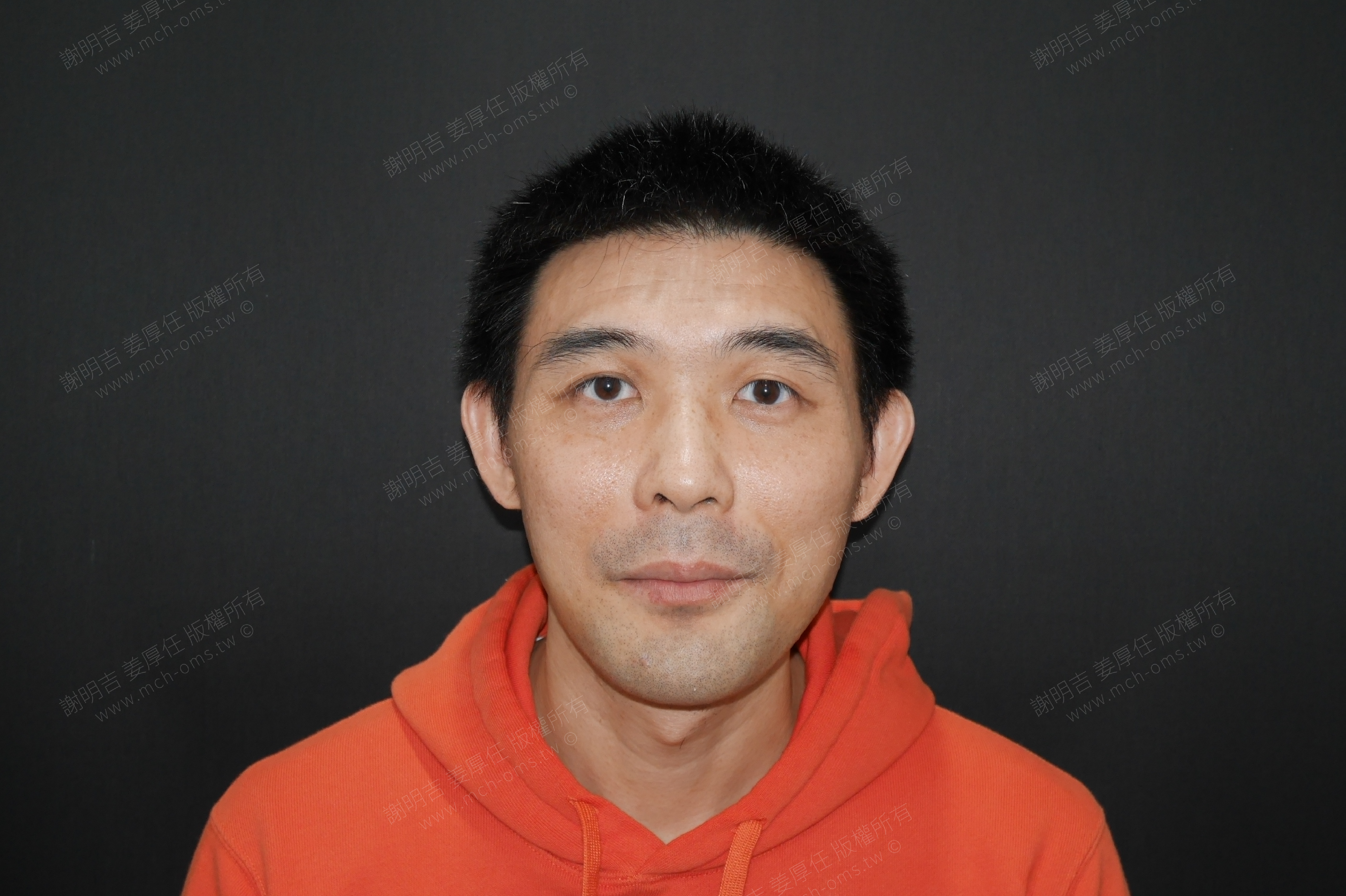 2018-01-02 3D customized orthognathic surgery photo 1