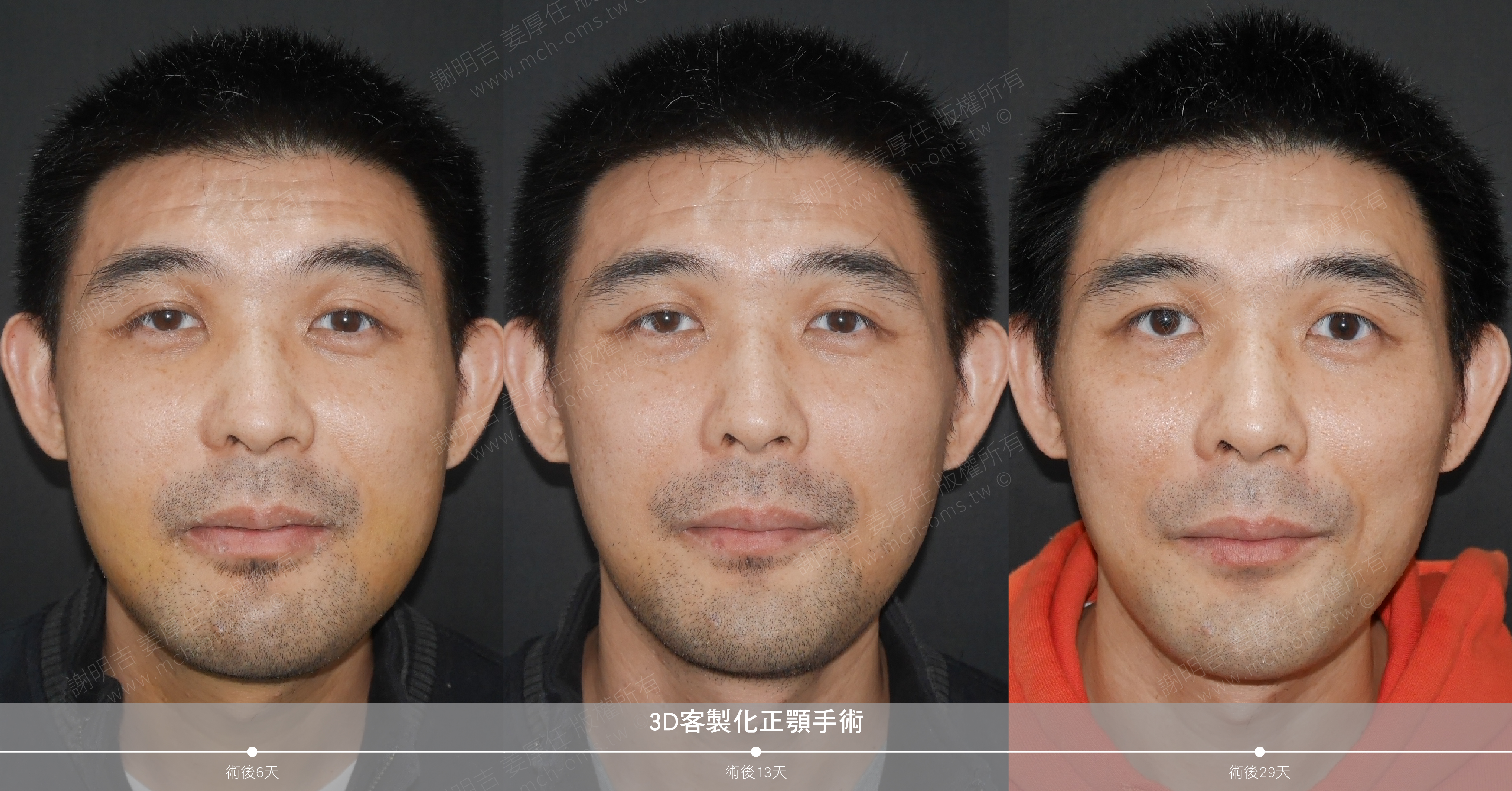 2018-01-02 3D customized orthognathic surgery