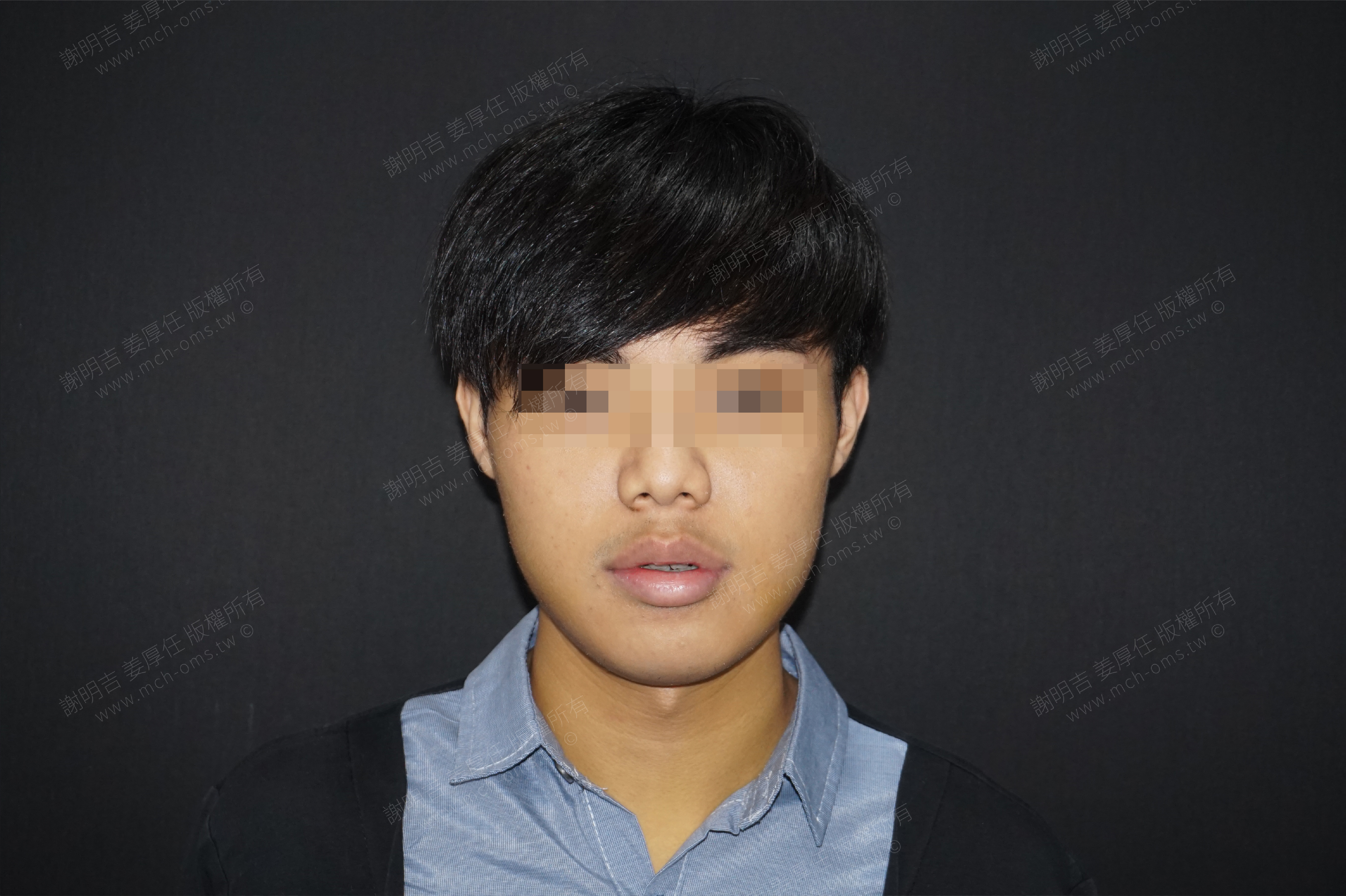 2017-06-26 3D customized orthognathic surgery (Part 2) photo 5