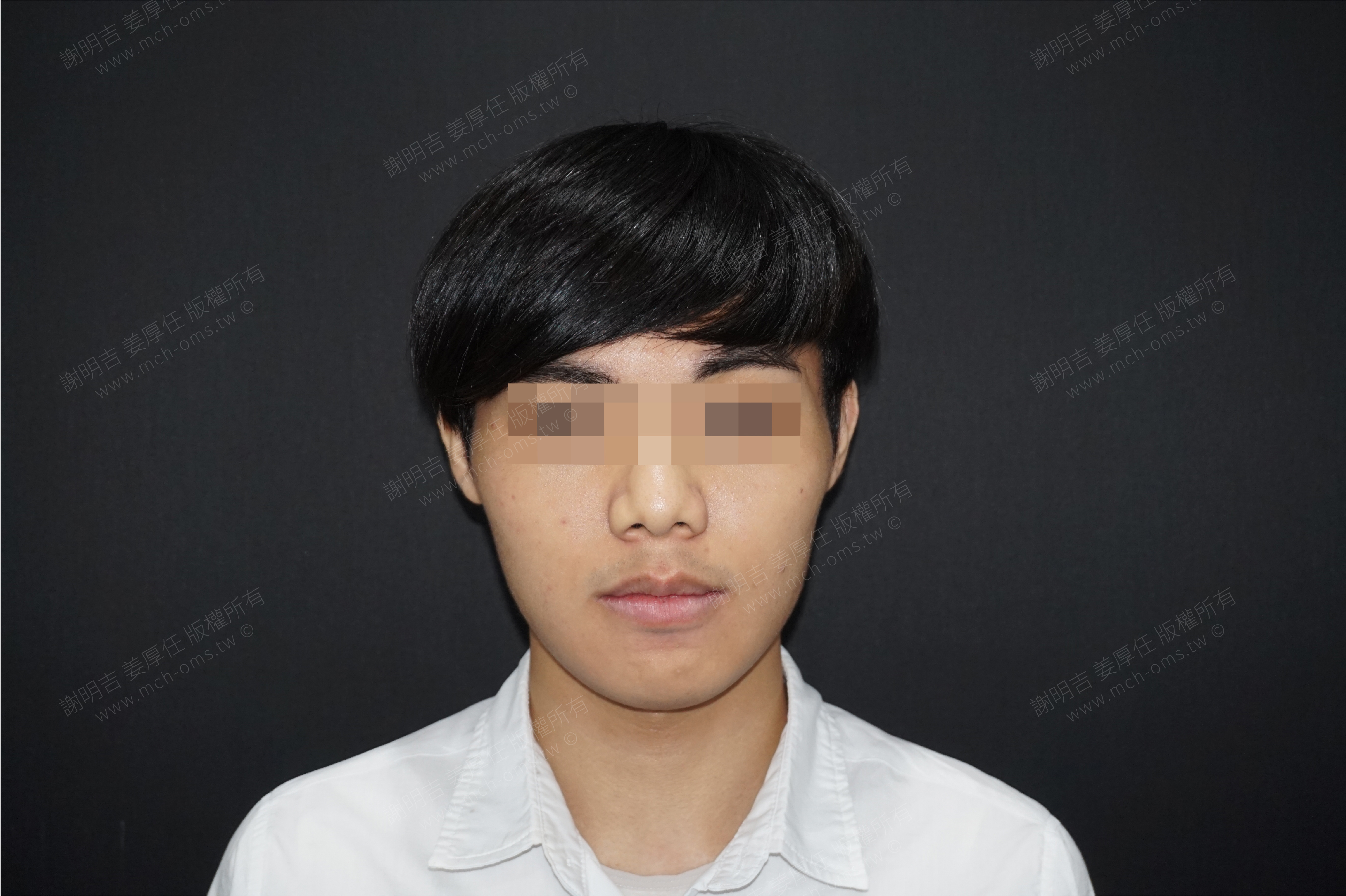 2017-06-26 3D customized orthognathic surgery (Part 2) photo 3