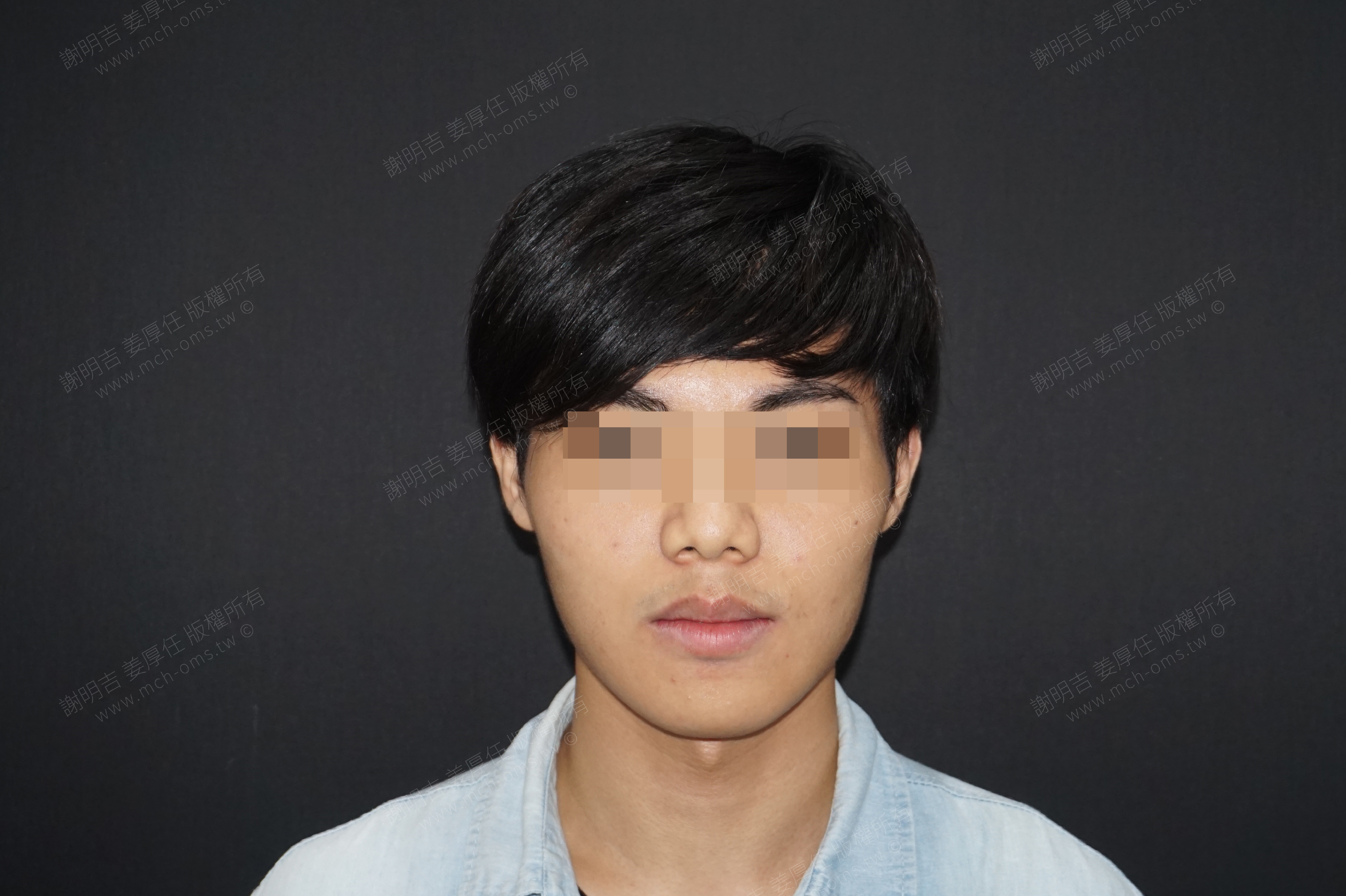 2017-06-26 3D customized orthognathic surgery (Part 2) photo 1