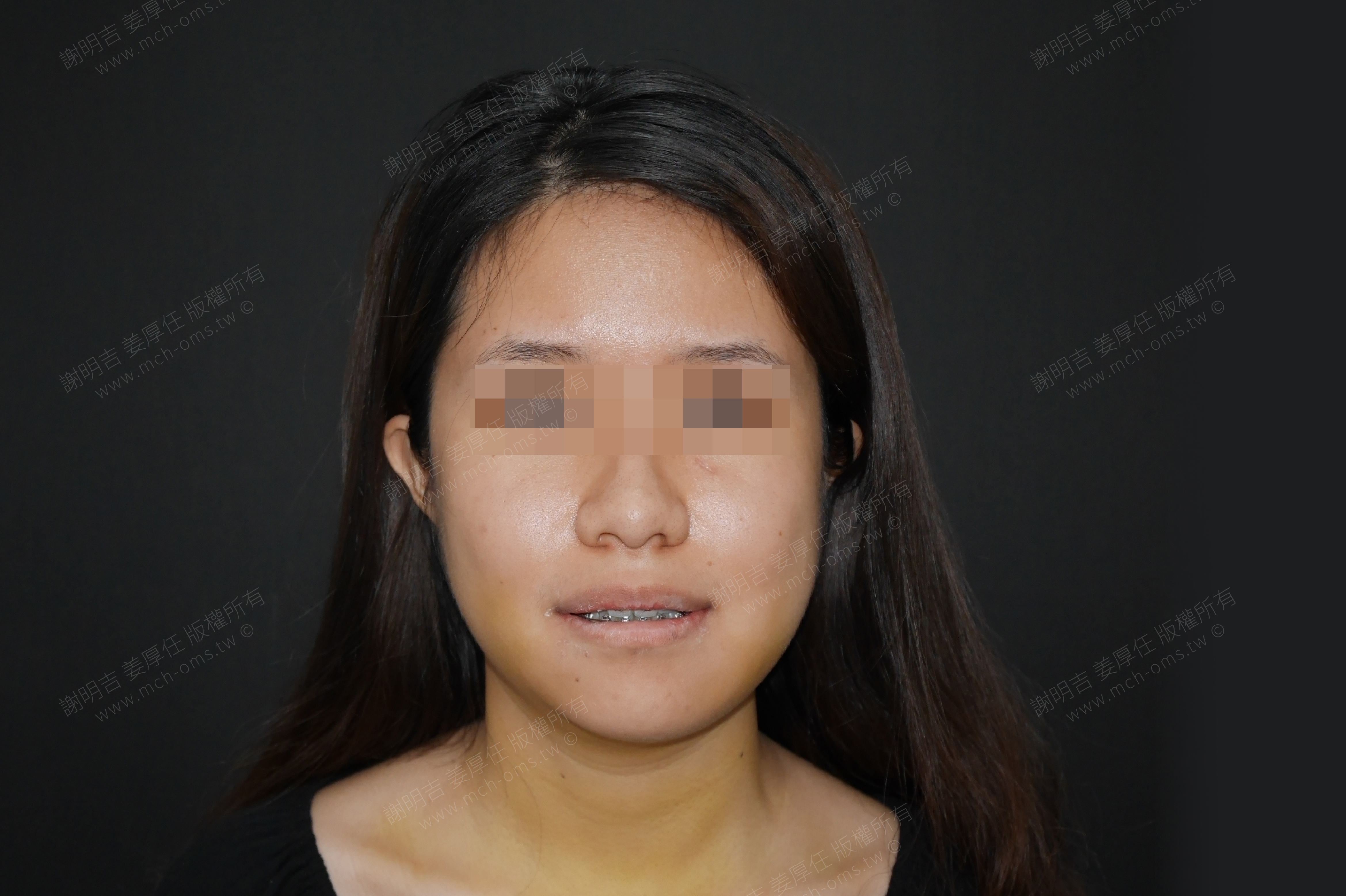 2017-07-24 3D customized orthognathic surgery (31 days after surgery) photo 5