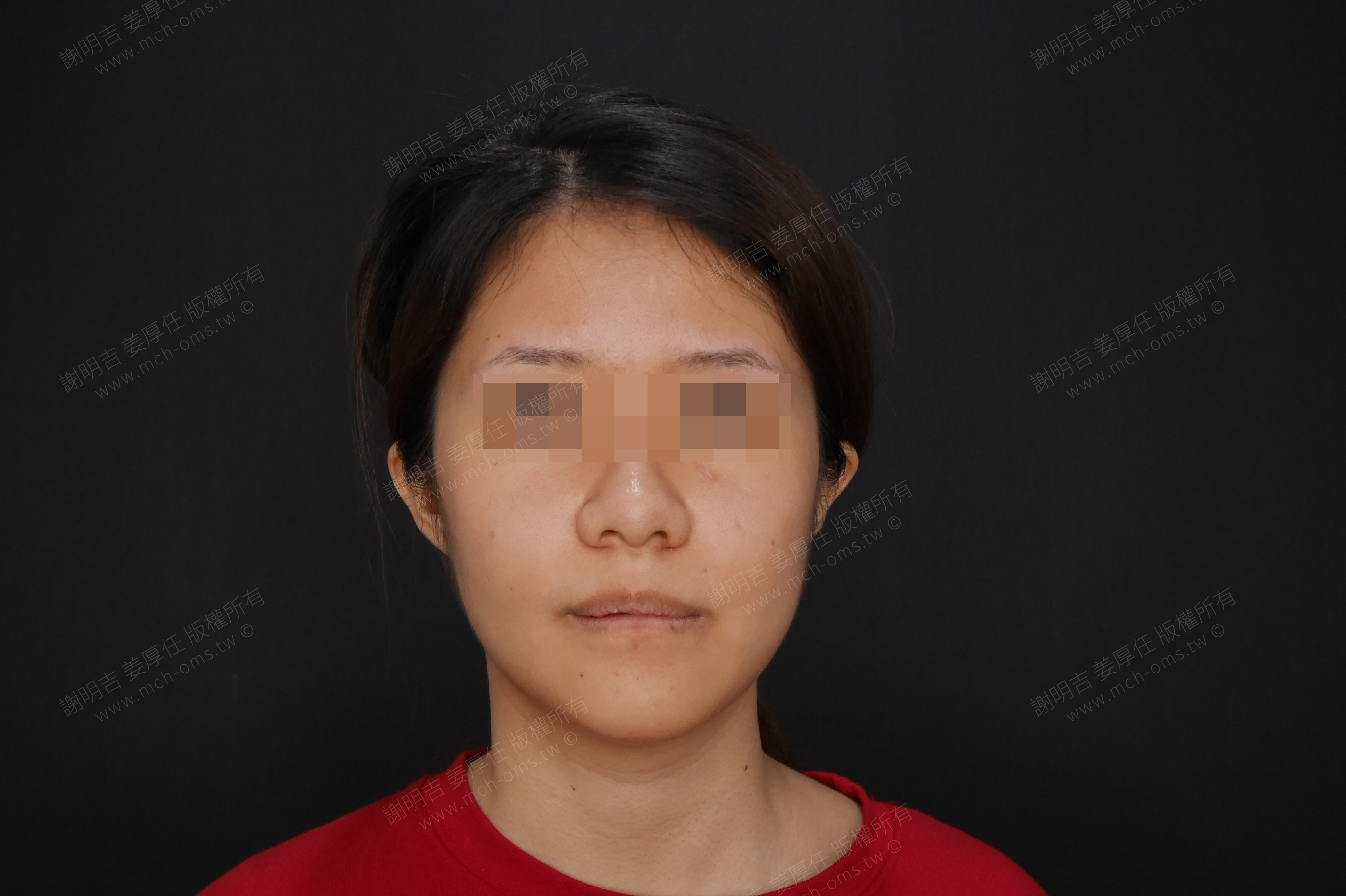 2017-07-24 3D customized orthognathic surgery (31 days after surgery) photo 1