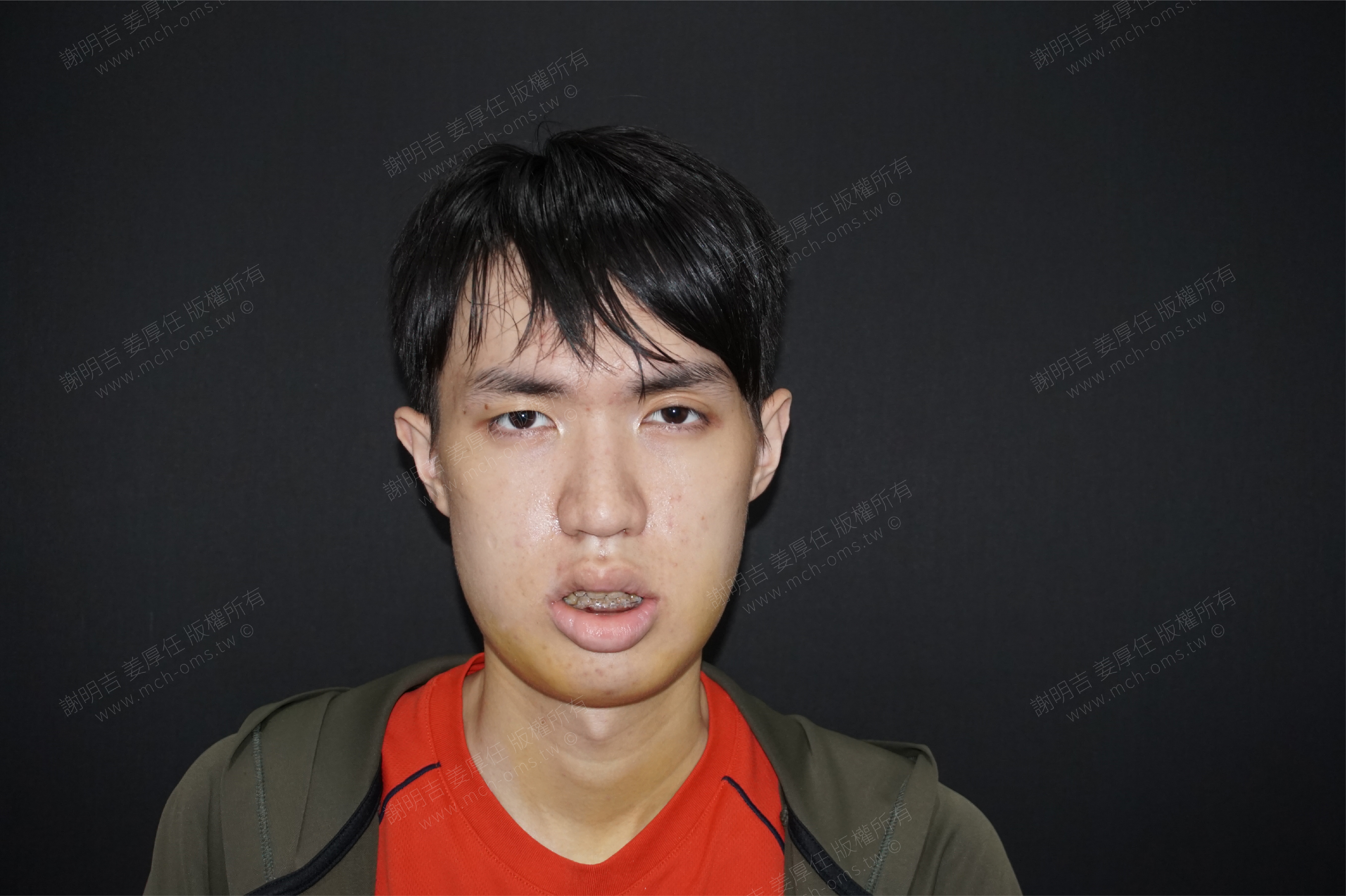 2017-08-09 3D customized orthognathic surgery photo 5