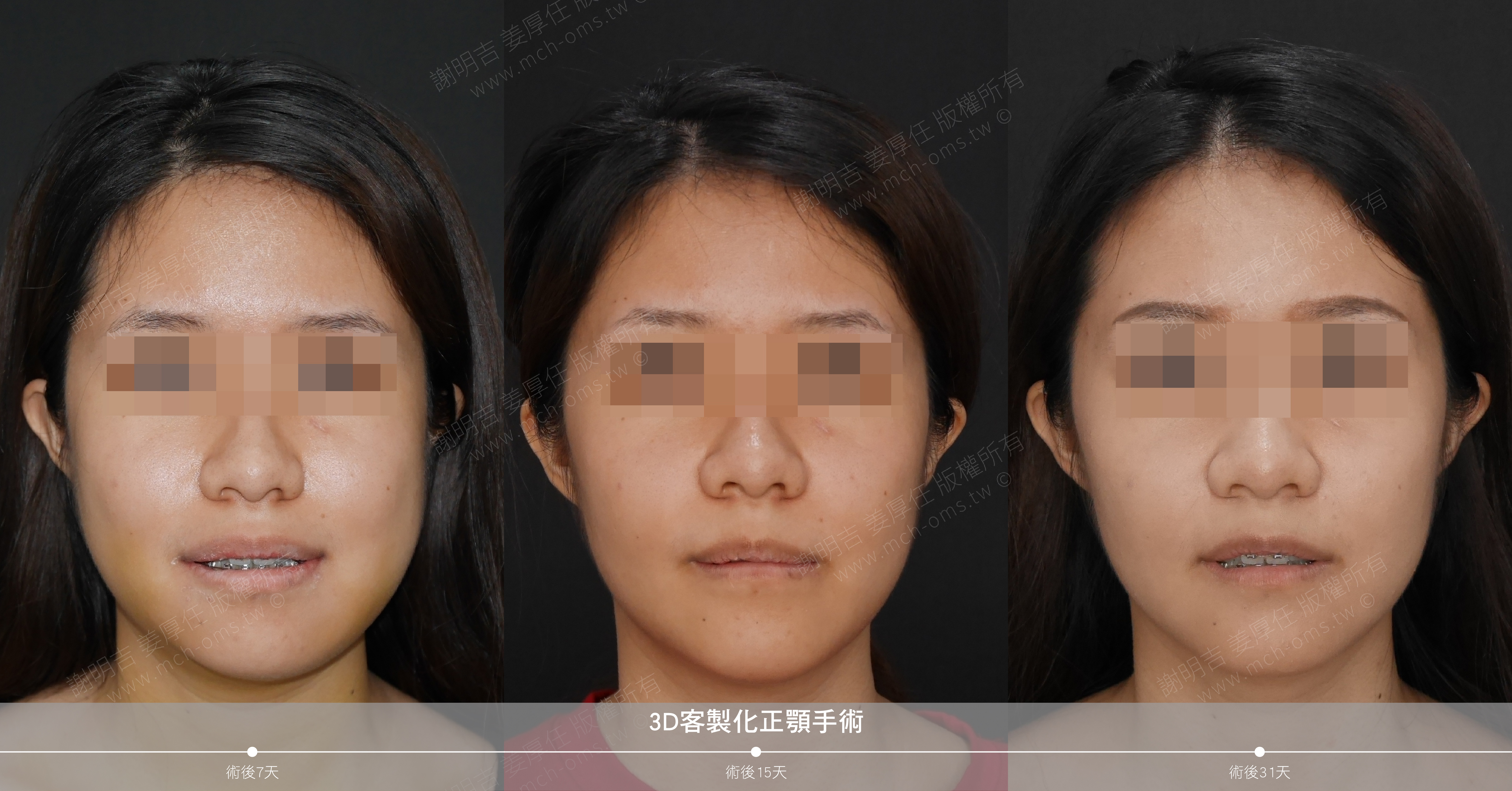 2017-07-24 3D customized orthognathic surgery (31 days after surgery)
