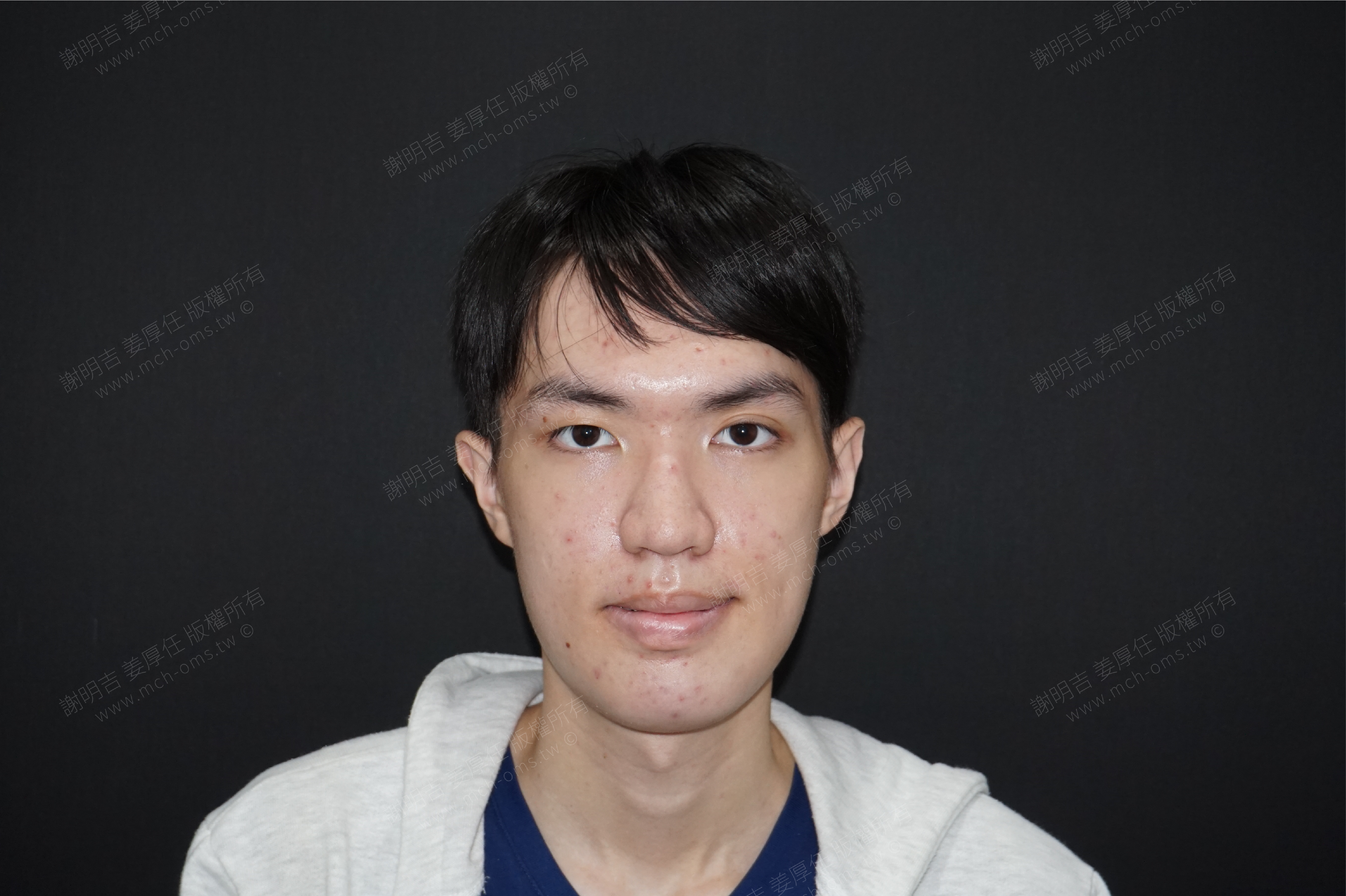 2017-08-09 3D customized orthognathic surgery photo 3