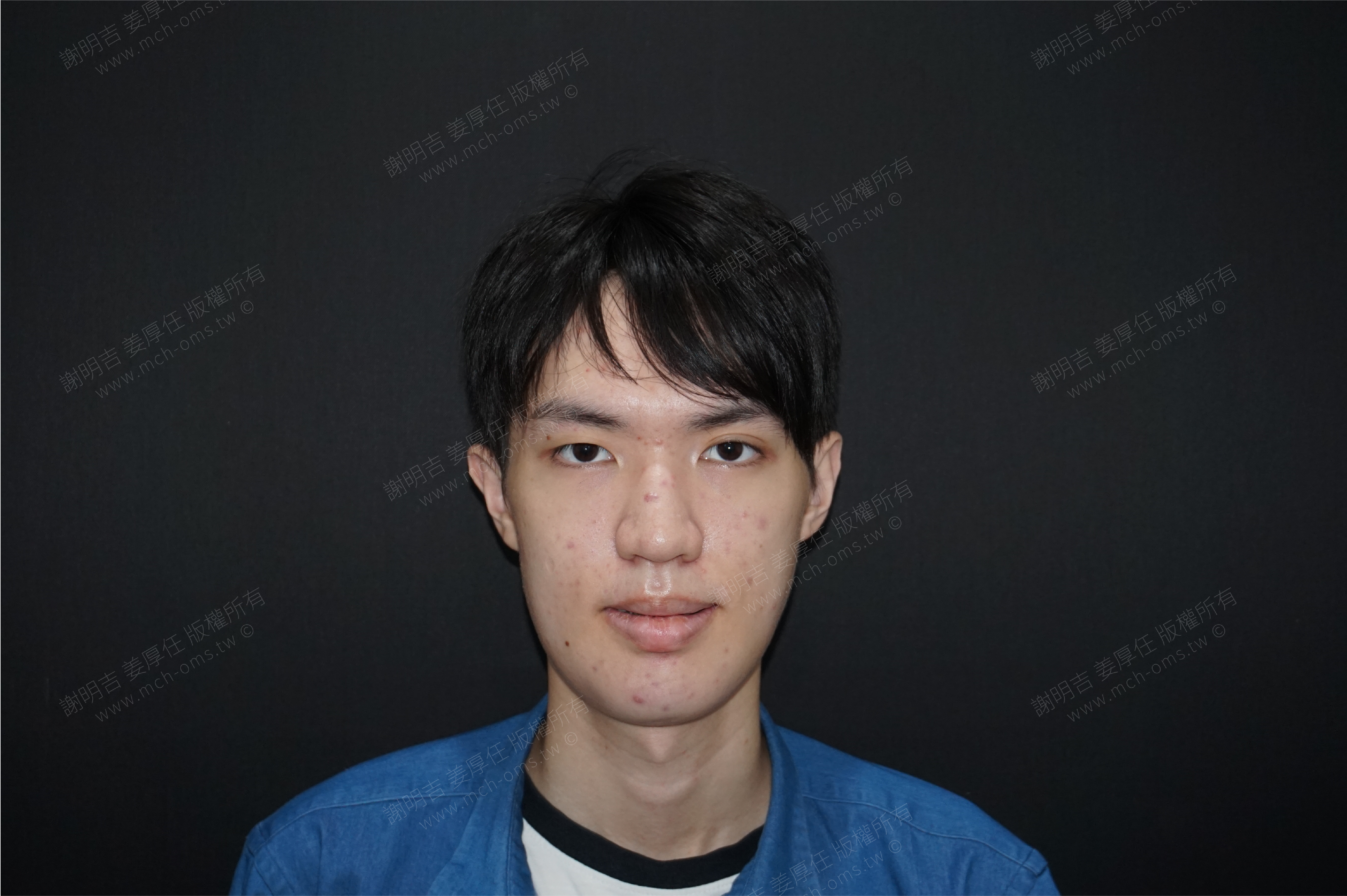 2017-08-09 3D customized orthognathic surgery photo 1