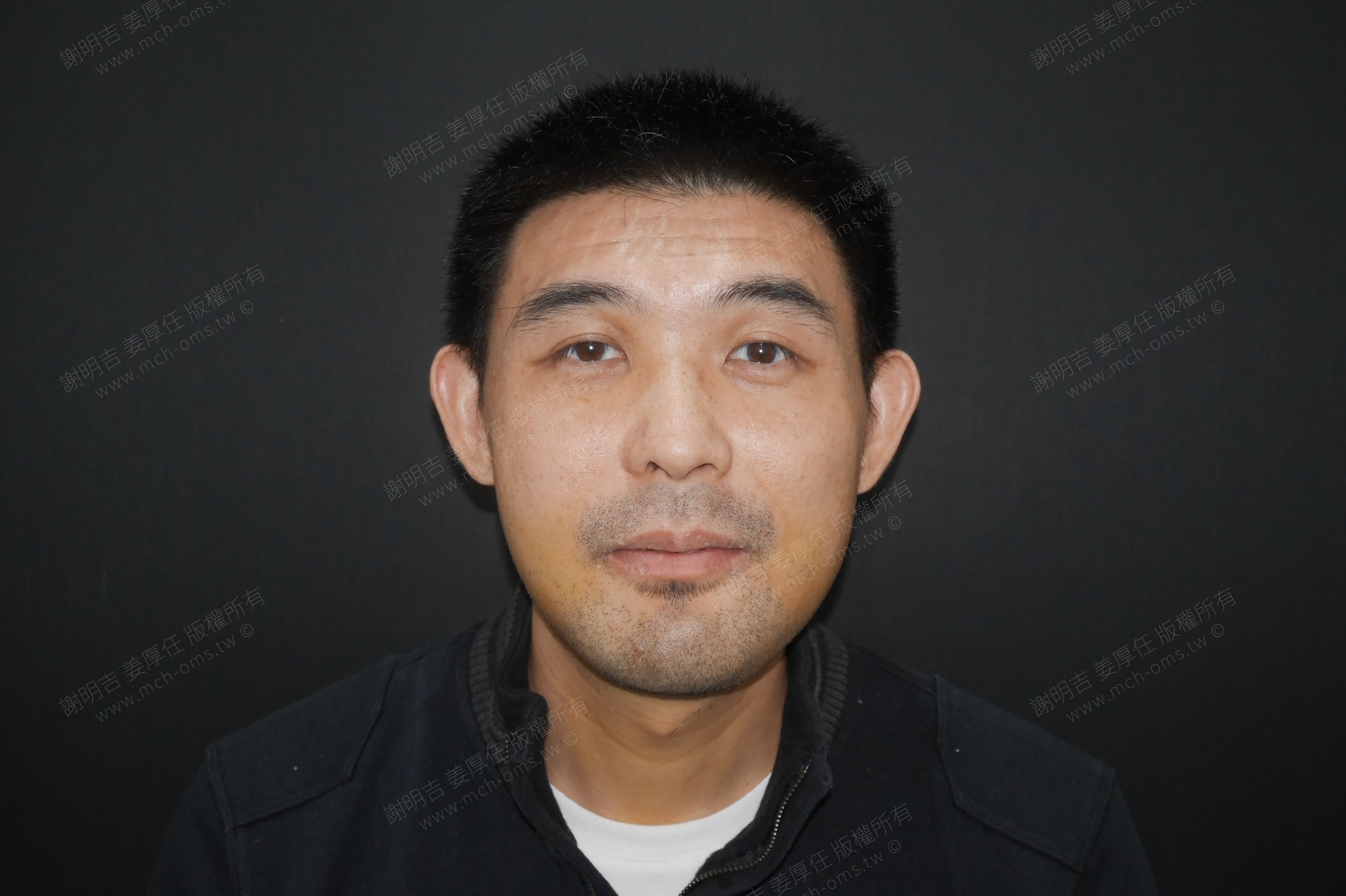 2018-01-02 3D customized orthognathic surgery photo 5