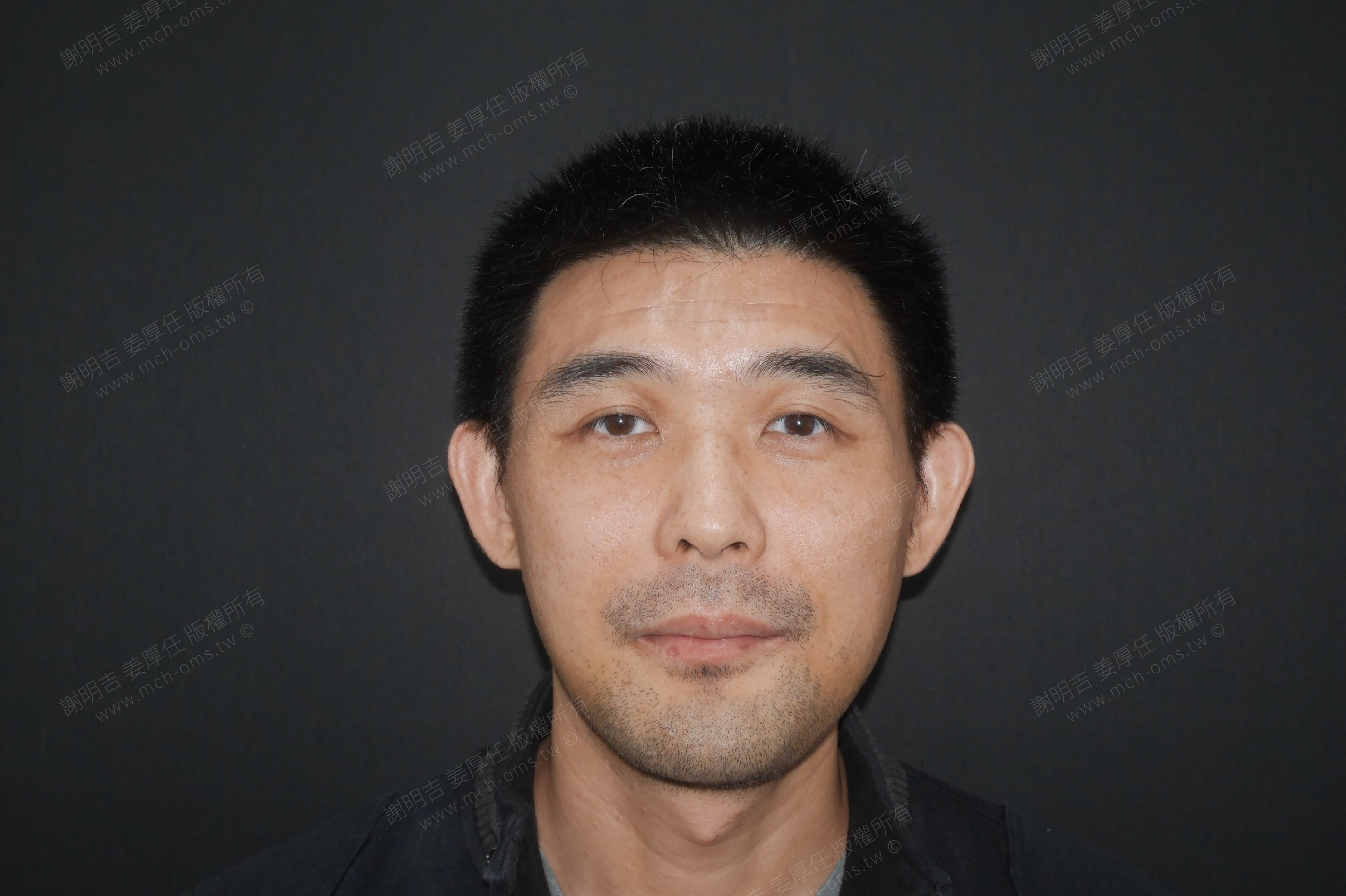 2018-01-02 3D customized orthognathic surgery photo 3