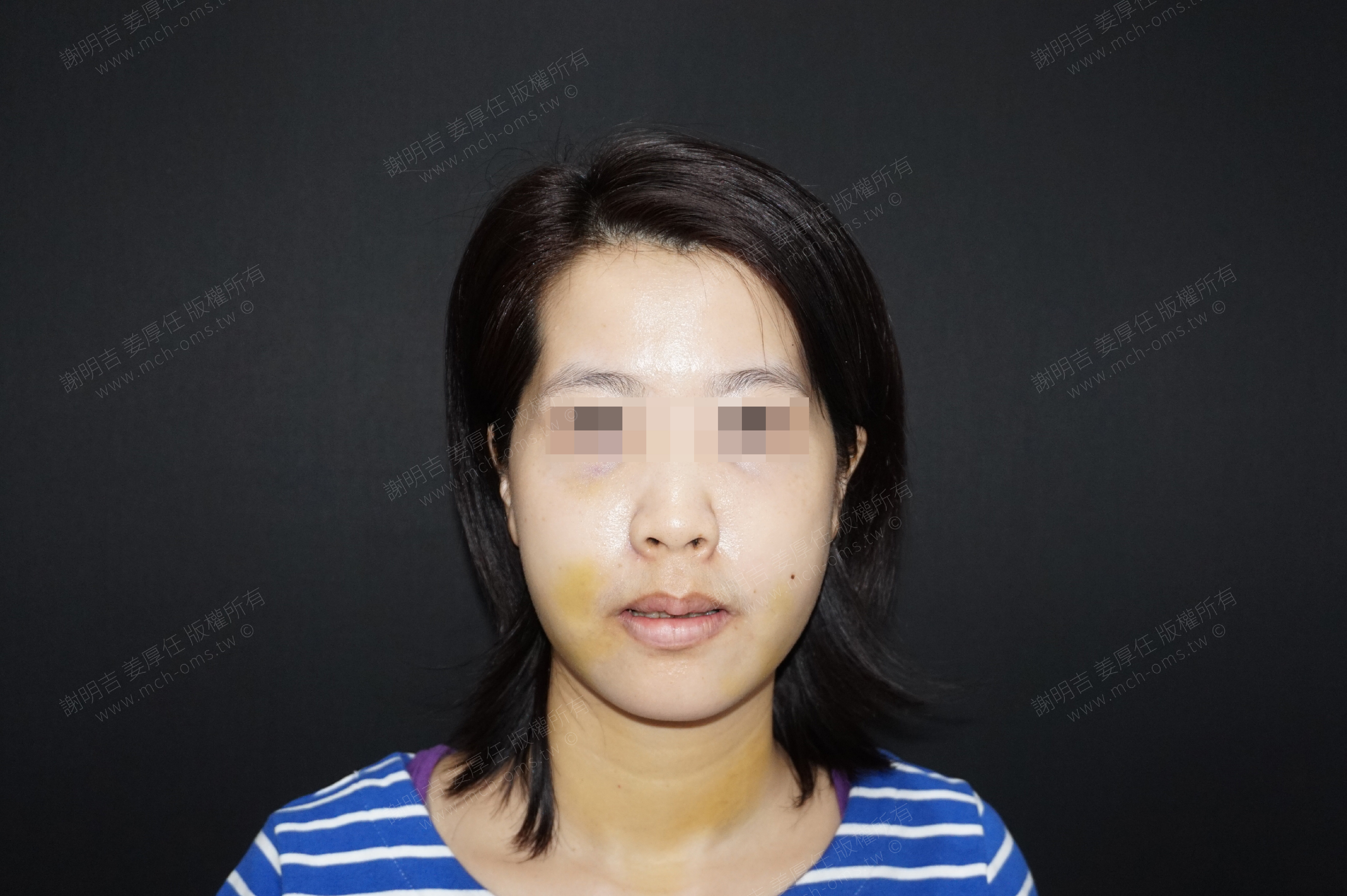 2018-03-17 3D customized orthognathic surgery (32 days after surgery) photo 5