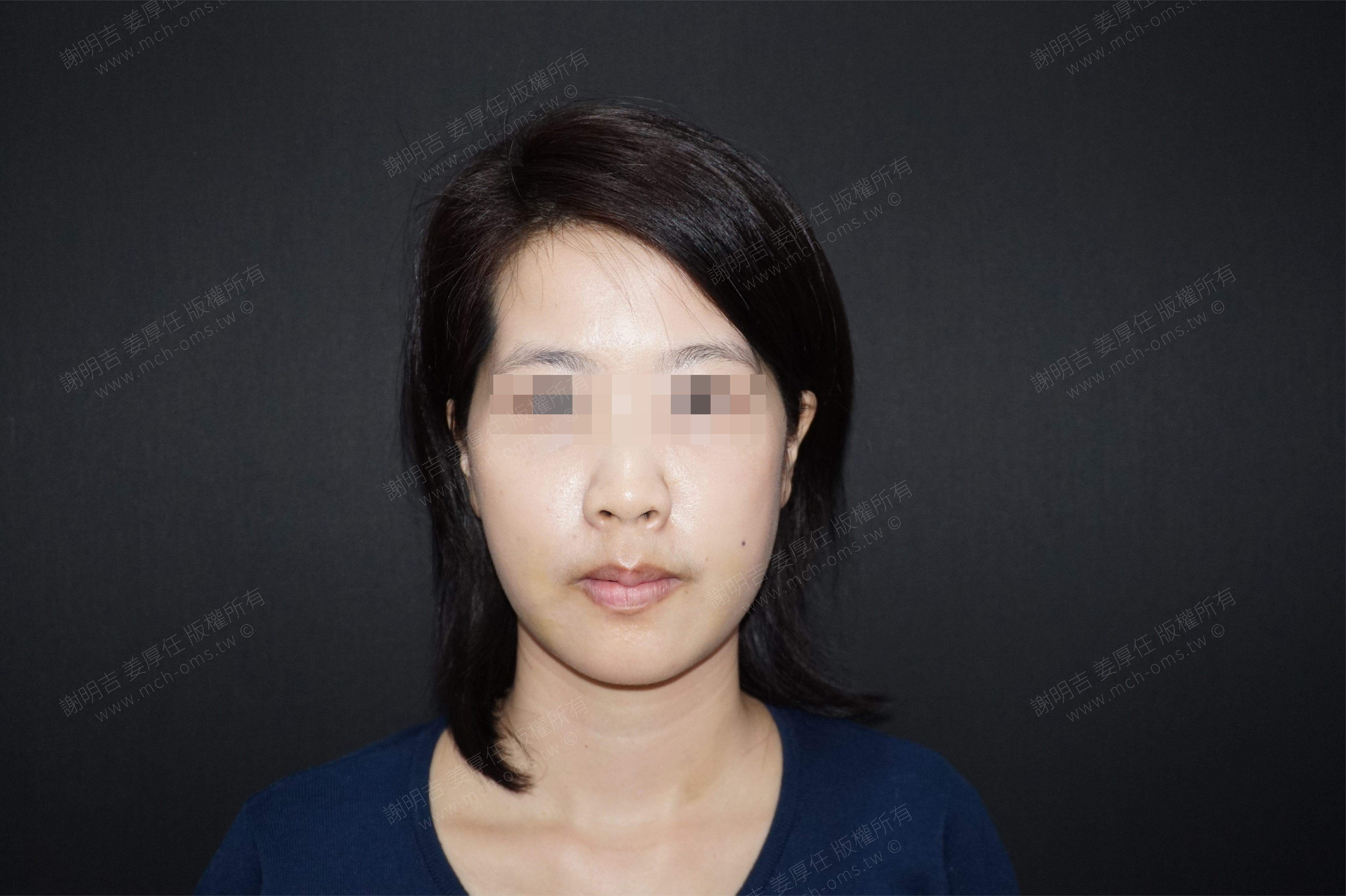 2018-03-17 3D customized orthognathic surgery (32 days after surgery) photo 3