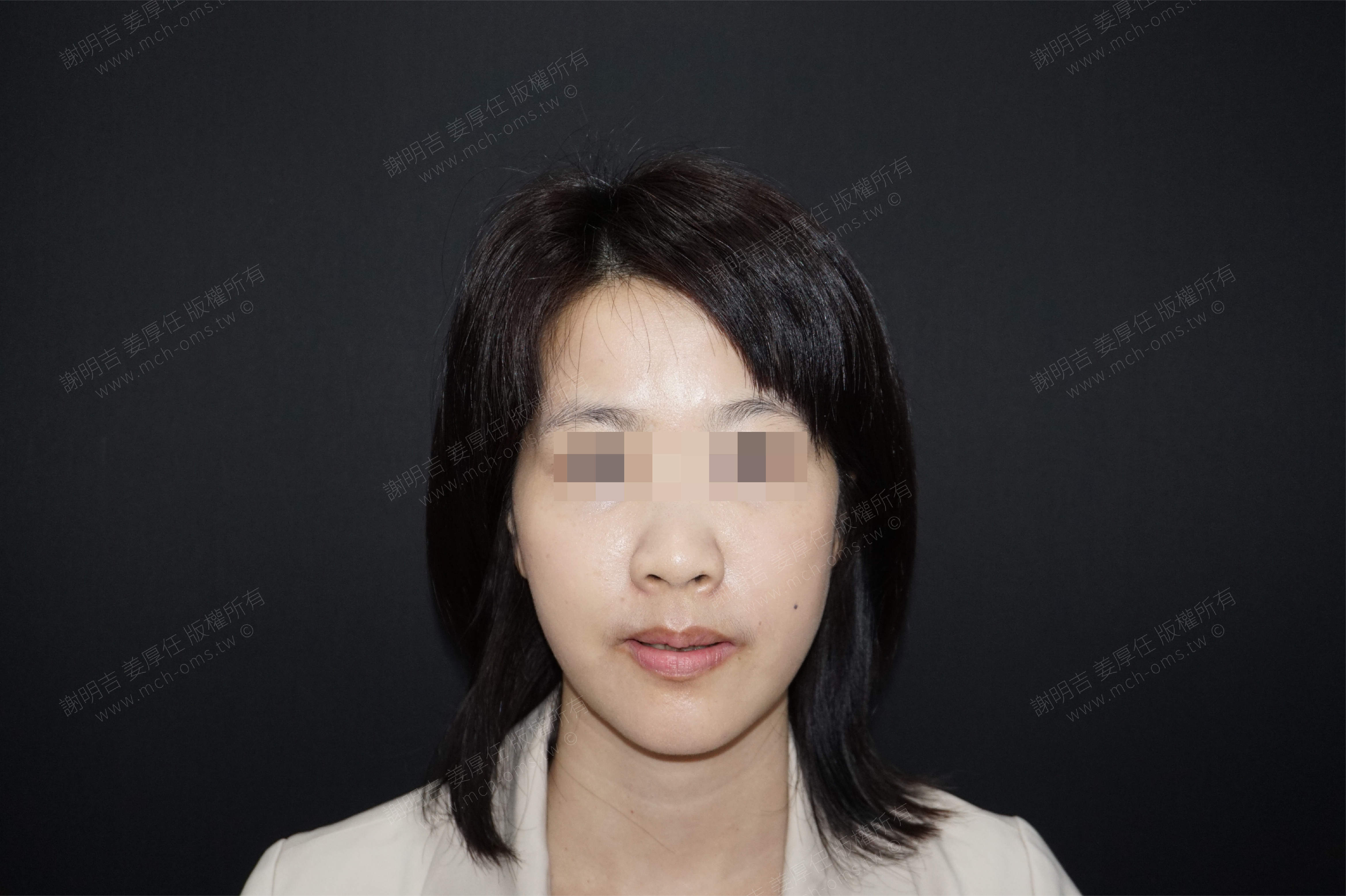 2018-03-17 3D customized orthognathic surgery (32 days after surgery) photo 1