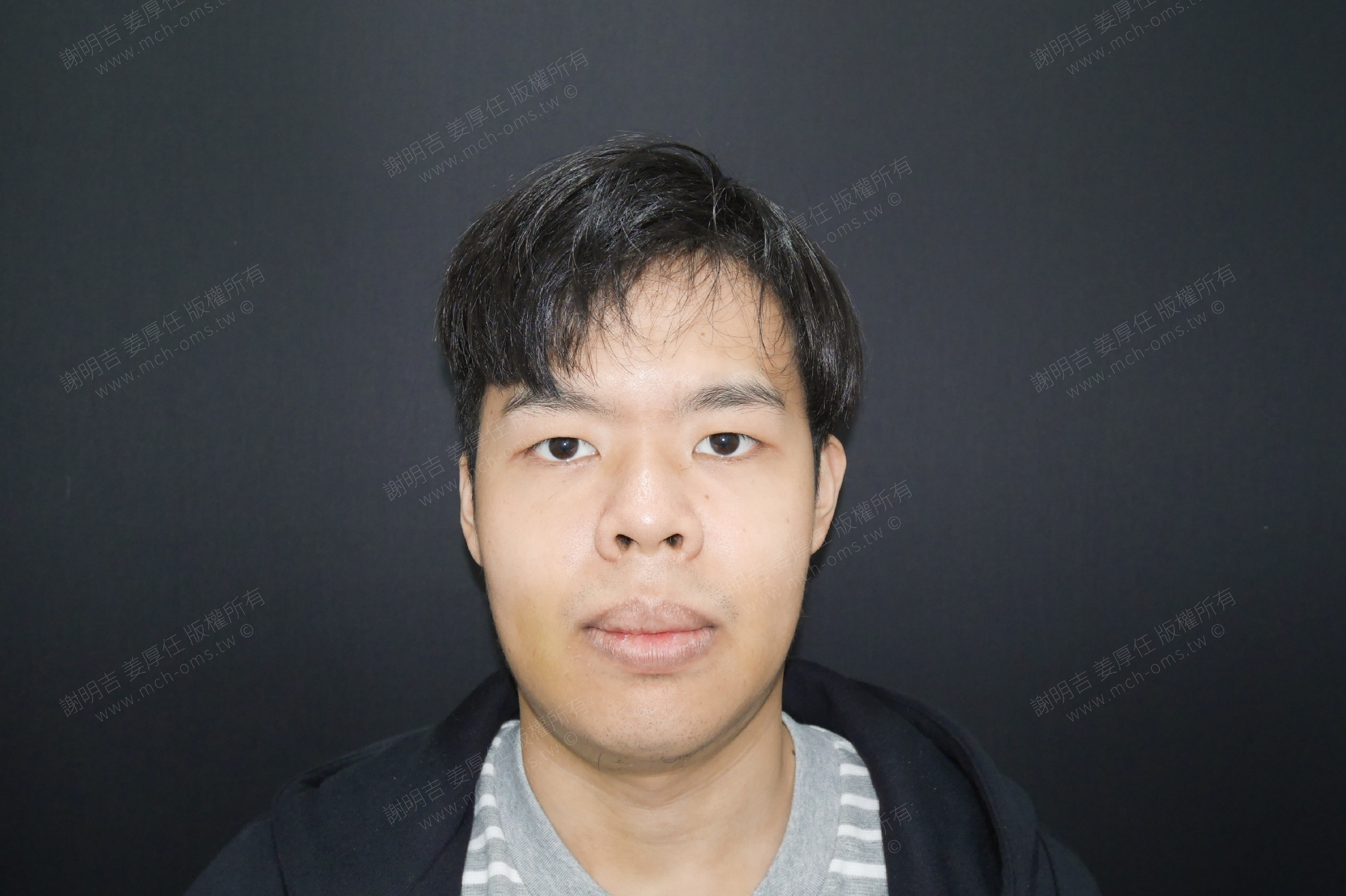 2018-04-14 3D客製化正顎手術（之一） 相關照片 3