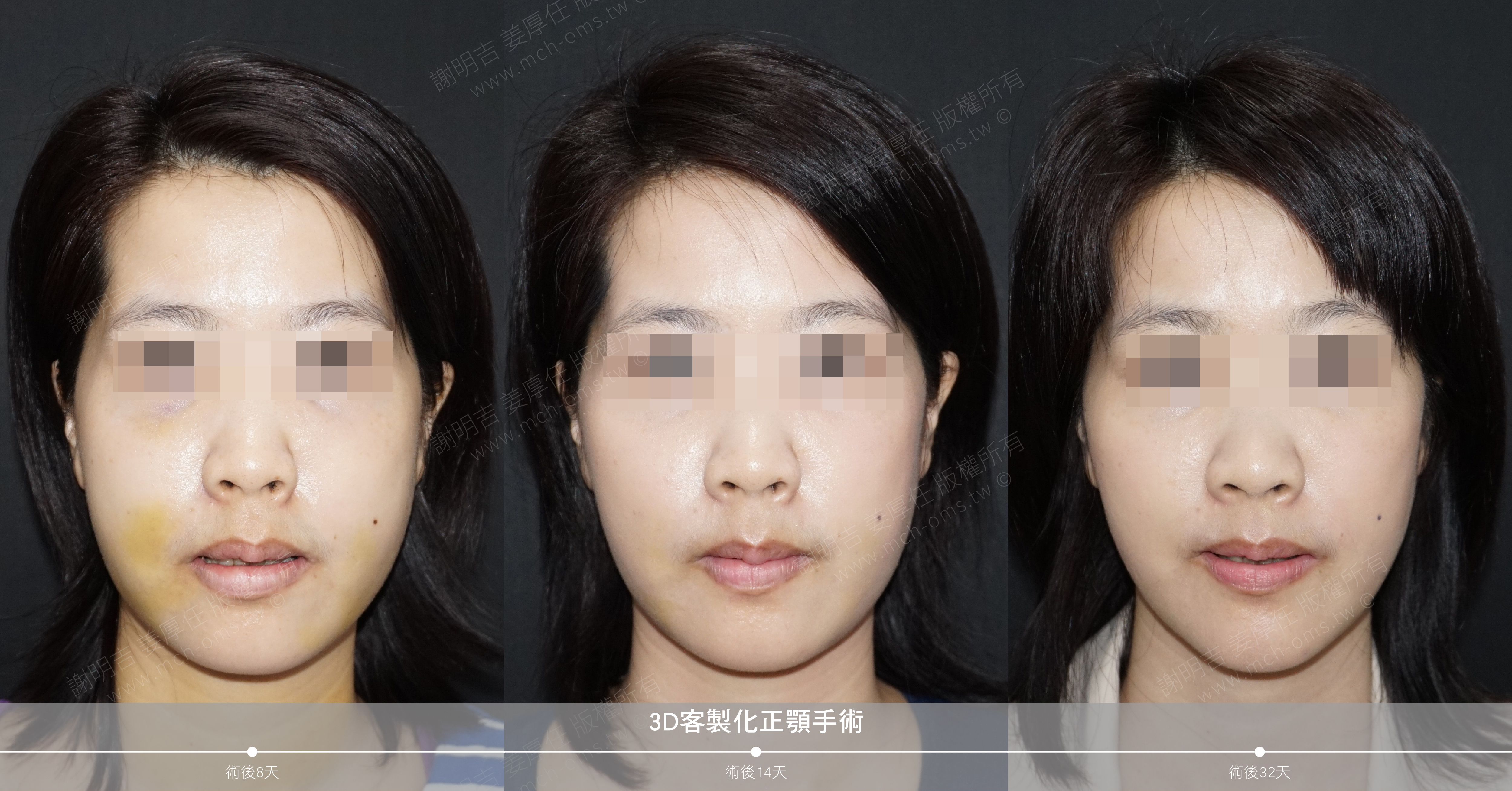 2018-03-17 3D customized orthognathic surgery (32 days after surgery)