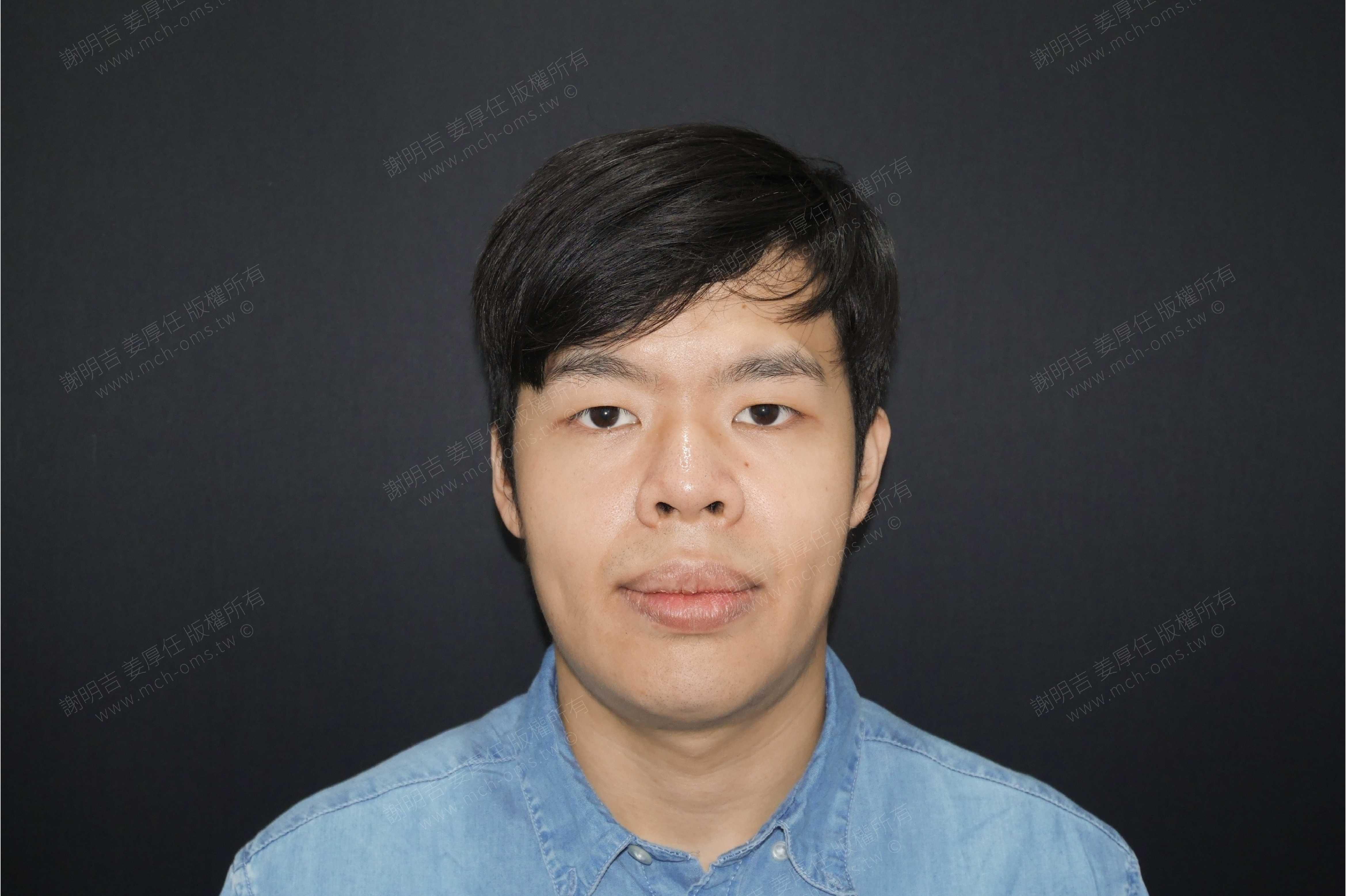 2018-04-14 3D客製化正顎手術（之一） 相關照片 1