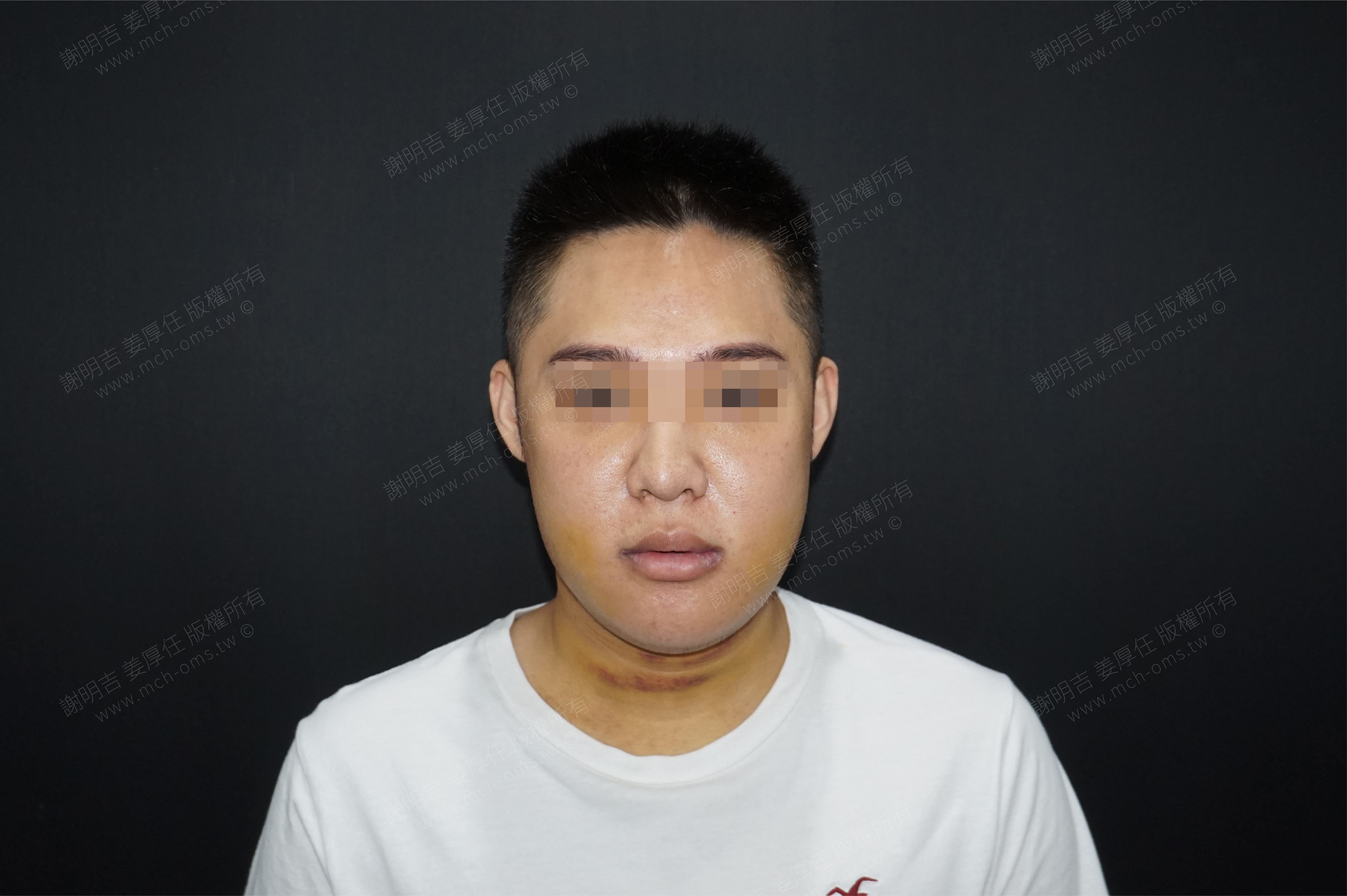 2018-09-29 3D客制化正颚手术(术后 38 天) 相关照片 5