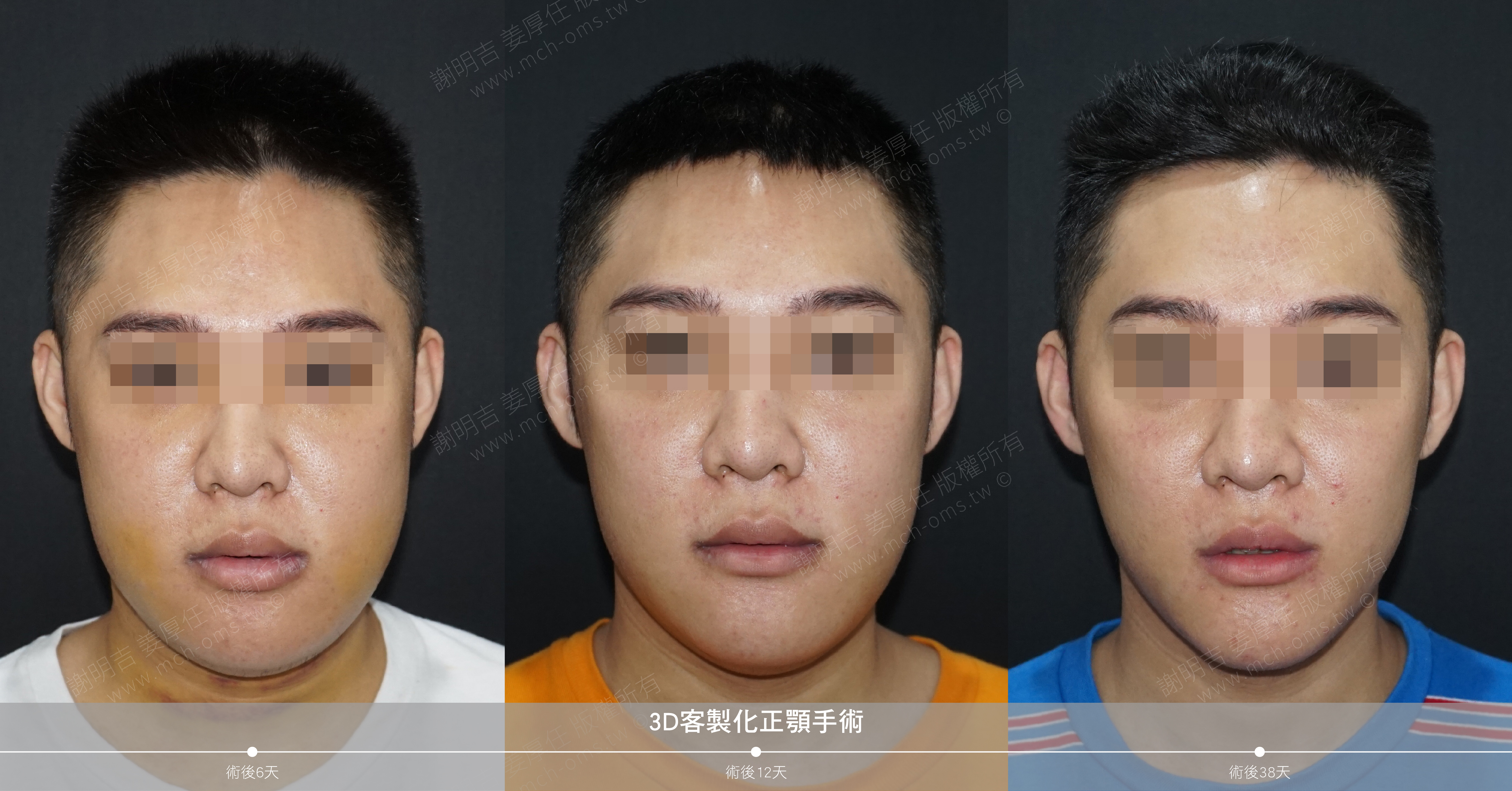 2018-09-29 3D客制化正颚手术(术后 38 天)