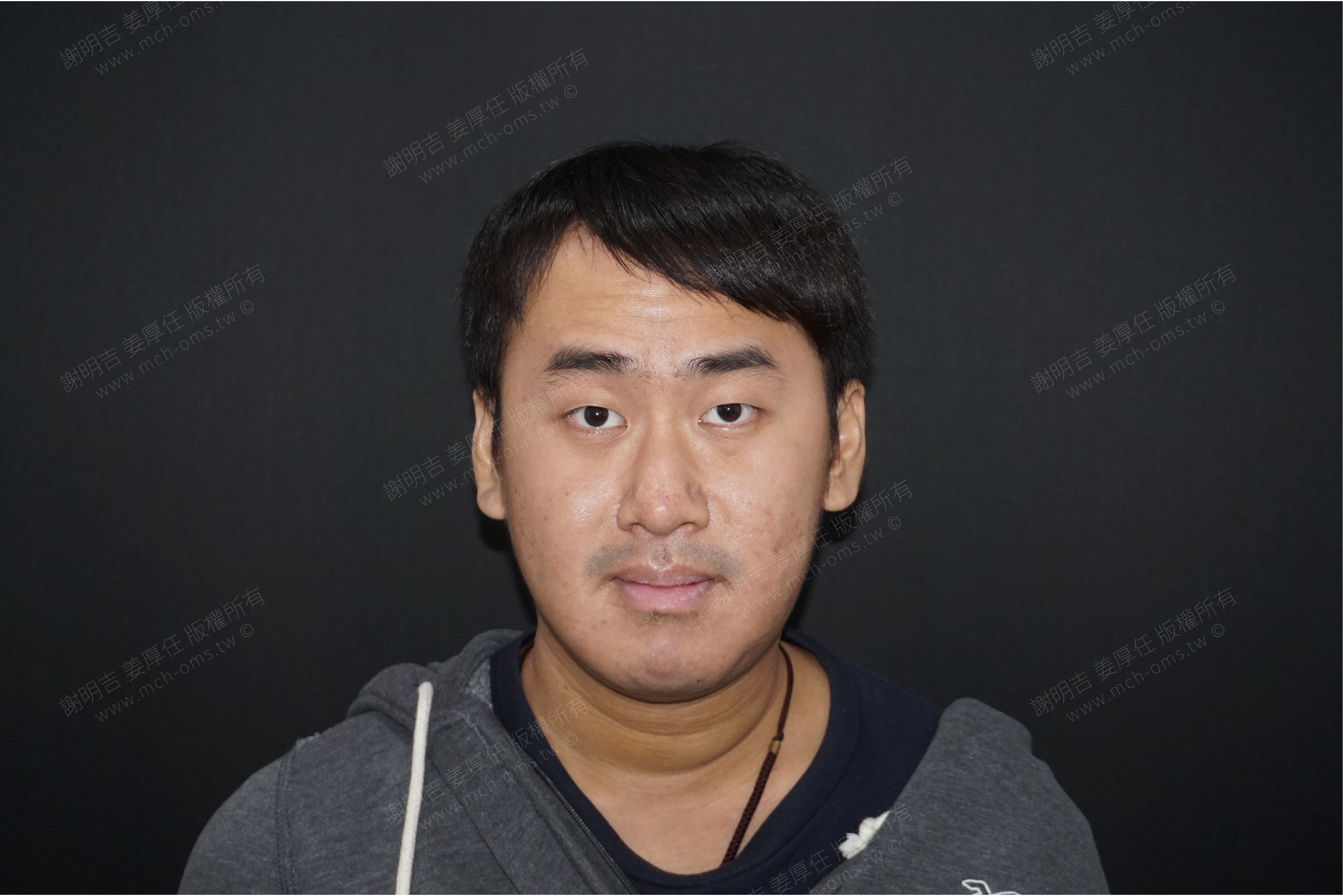 2019-01-05 3D客製化正顎手術 相關照片 5