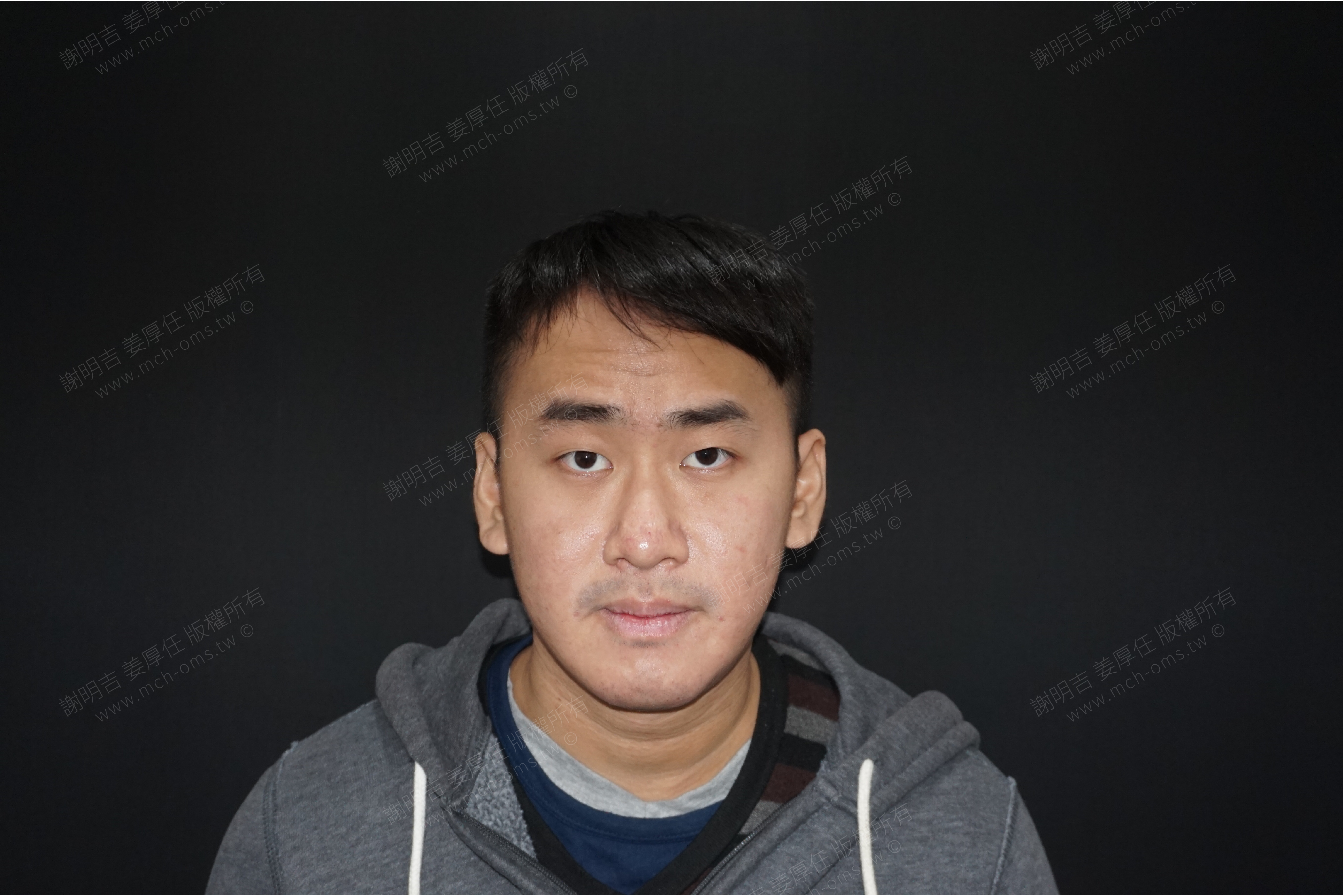 2019-01-05 3D客製化正顎手術 相關照片 3