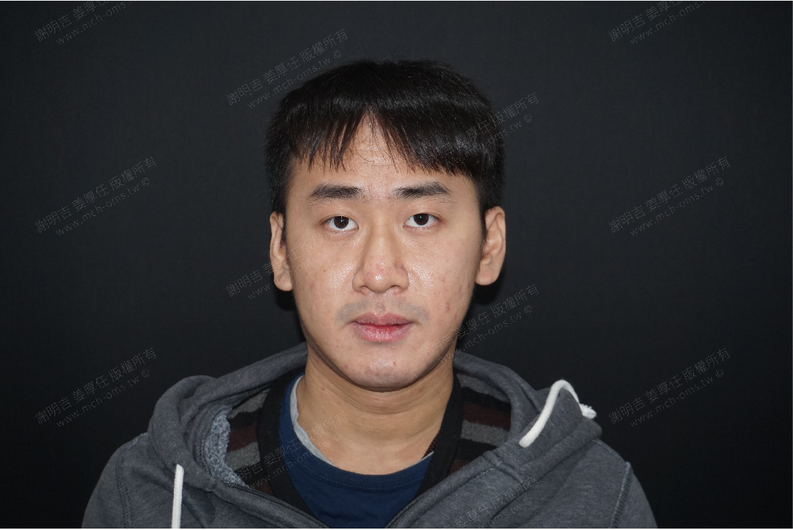 2019-01-05 3D客製化正顎手術 相關照片 1