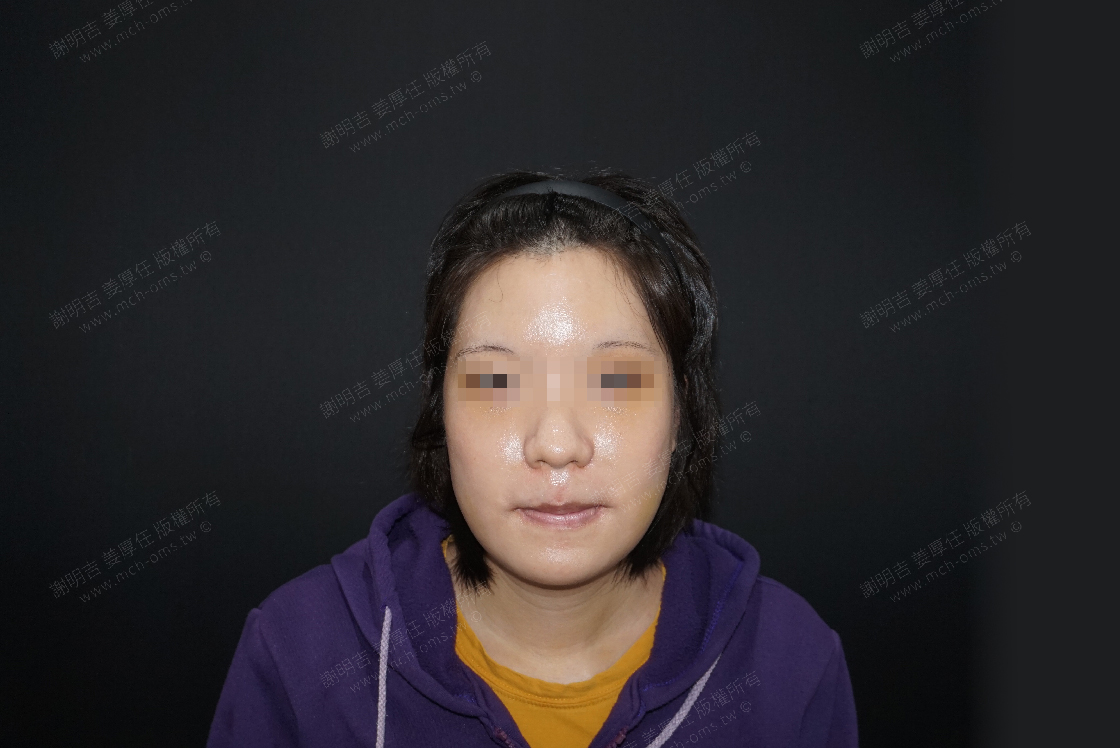 2019-02-02 Forehead cosmetic surgery + 3D customized zygomatic infolding surgery + 3D customized orthognathic surgery photo 5