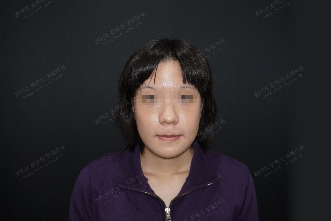 2019-02-02 Forehead cosmetic surgery + 3D customized zygomatic infolding surgery + 3D customized orthognathic surgery photo 3