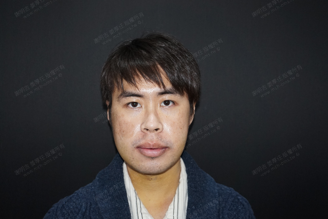 2019-02-11 3D客制化正颚手术 相关照片 5