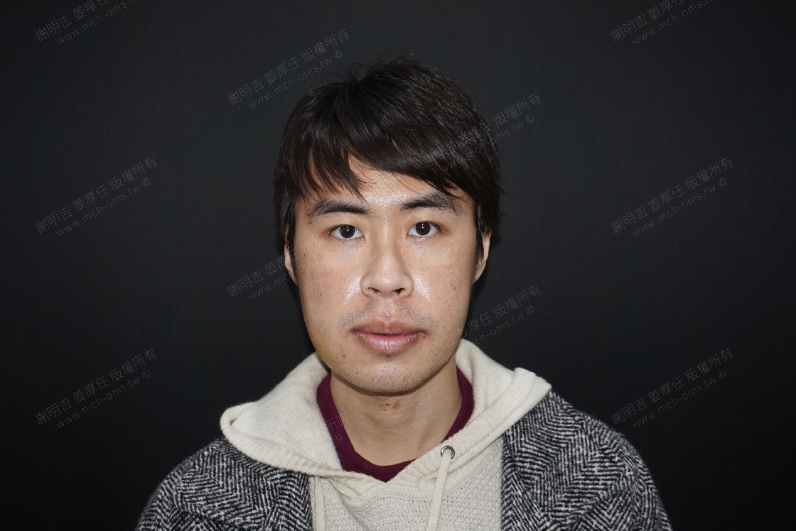 2019-02-11 3D客制化正颚手术 相关照片 3