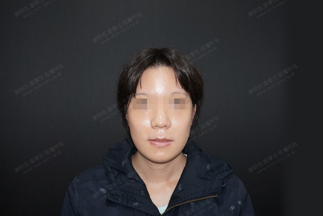 2019-02-02 Forehead cosmetic surgery + 3D customized zygomatic infolding surgery + 3D customized orthognathic surgery photo 1
