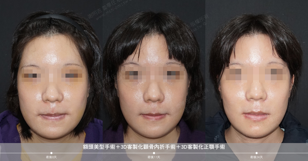 2019-02-02 Forehead cosmetic surgery + 3D customized zygomatic infolding surgery + 3D customized orthognathic surgery