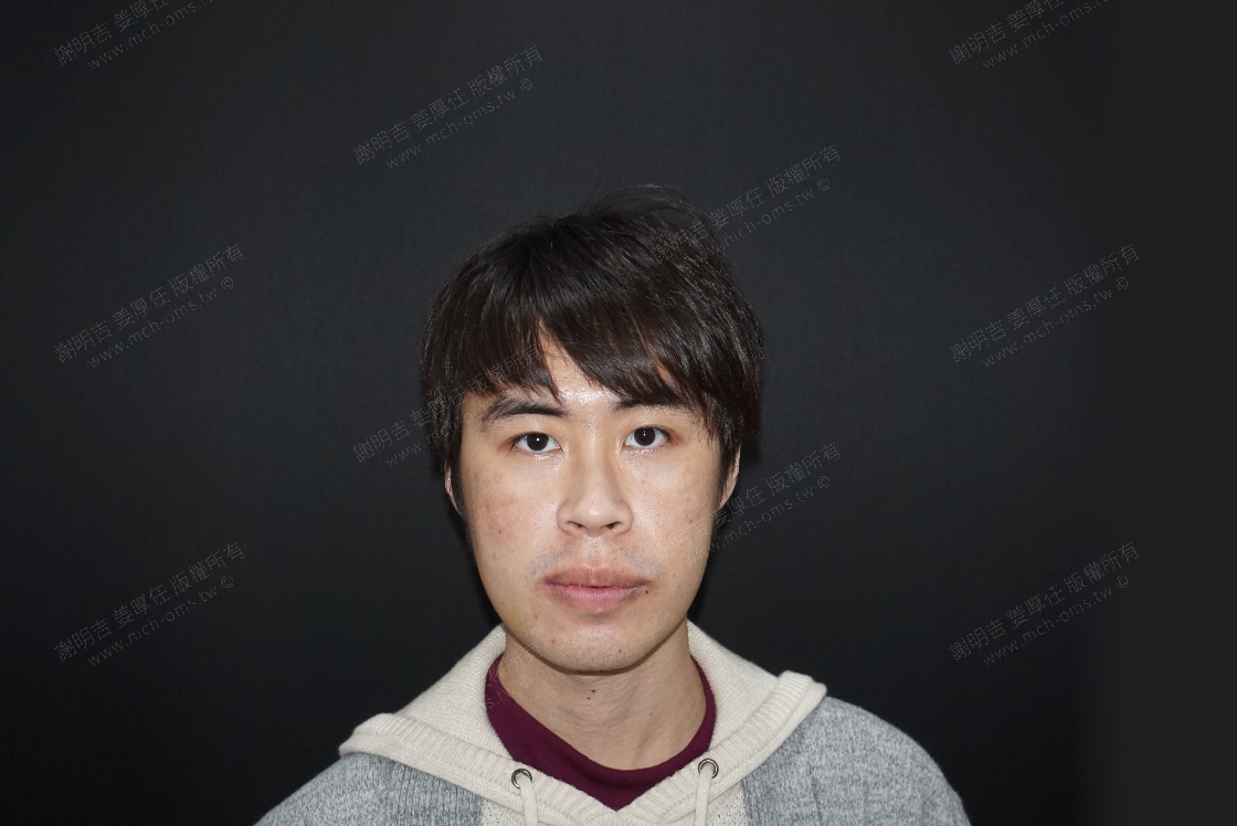 2019-02-11 3D客制化正颚手术 相关照片 1