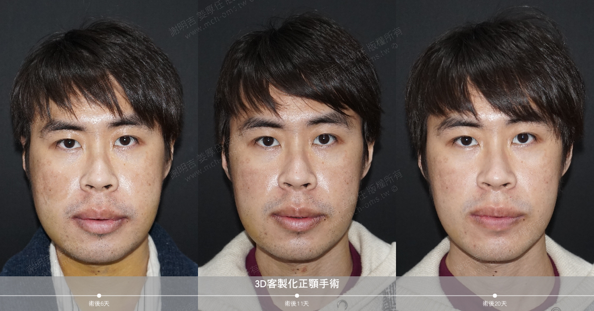 2019-02-11 3D客制化正颚手术