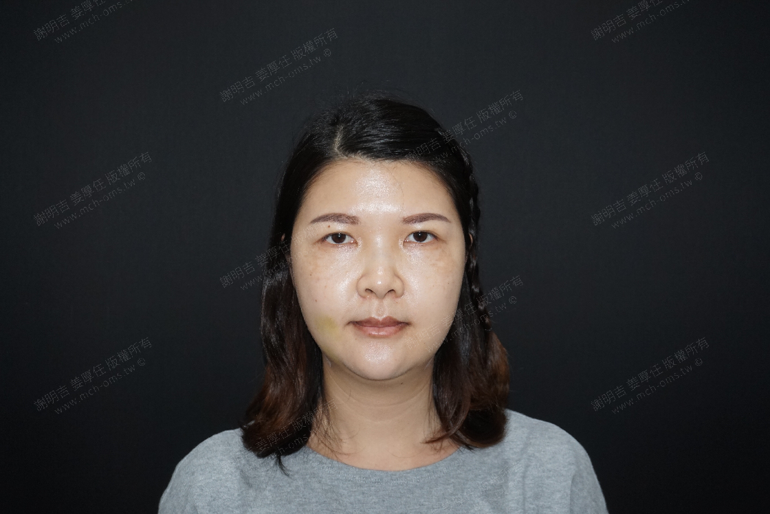 2019-03-09 3D客製化正顎手術 相關照片 3