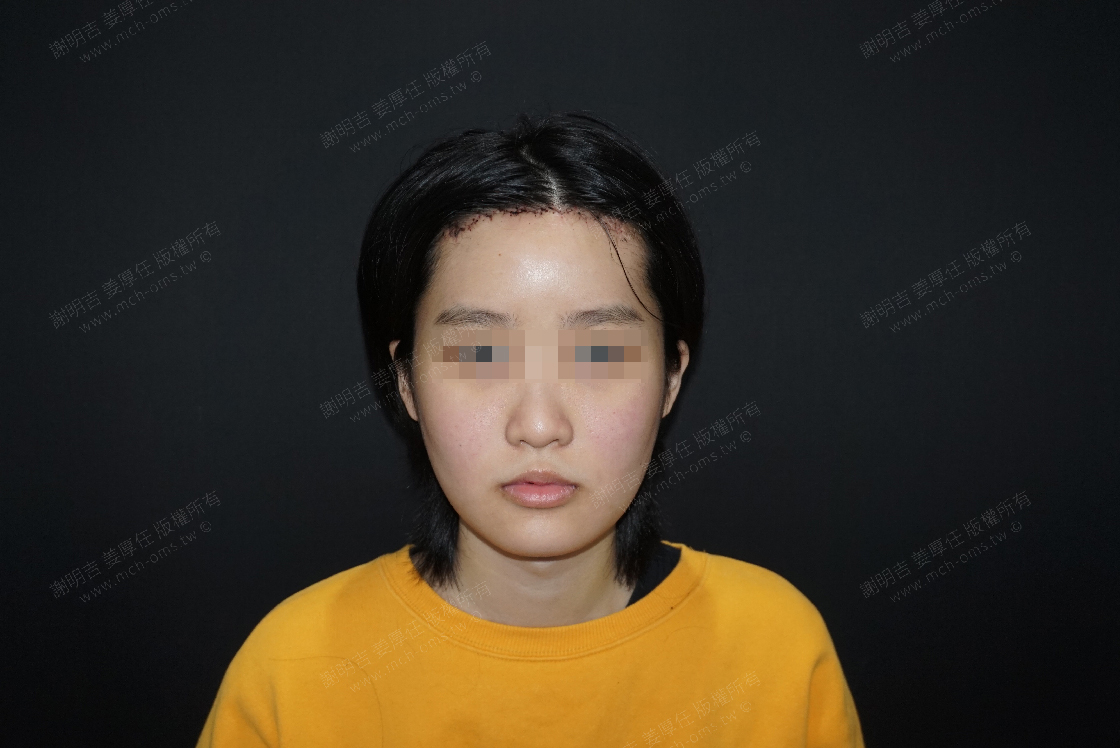 2019-03-22 额头美型手术+3D客制化颧骨内折手术+下巴V-Line削骨手术 相关照片 3