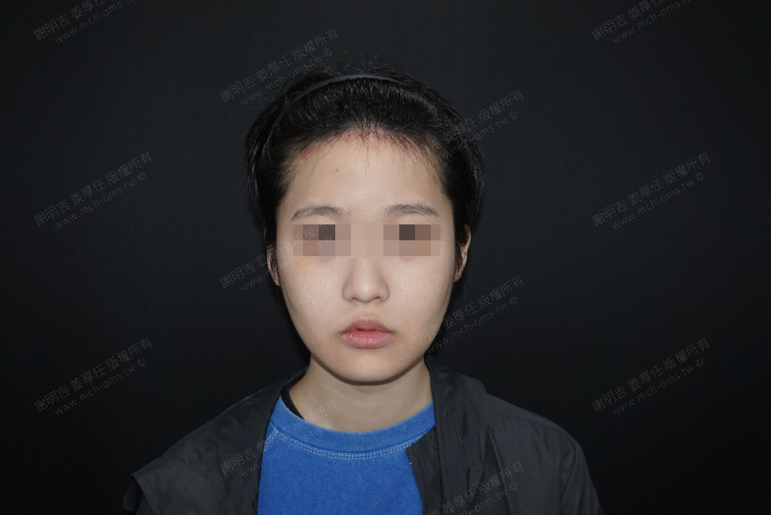 2019-03-22 额头美型手术+3D客制化颧骨内折手术+下巴V-Line削骨手术 相关照片 1