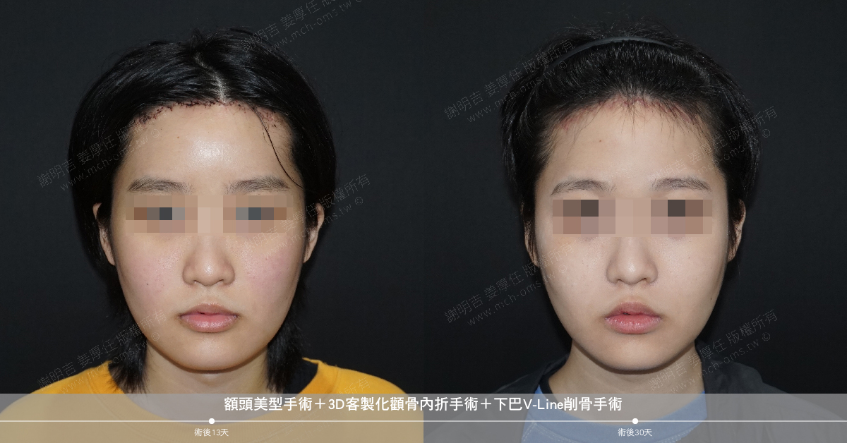 2019-03-22 额头美型手术+3D客制化颧骨内折手术+下巴V-Line削骨手术