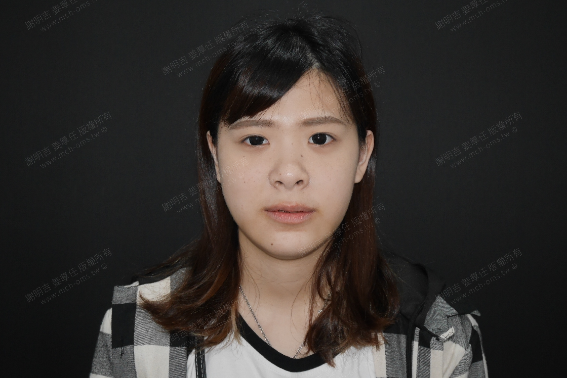 2019-05-18 3D客製化正顎手術 相關照片 3