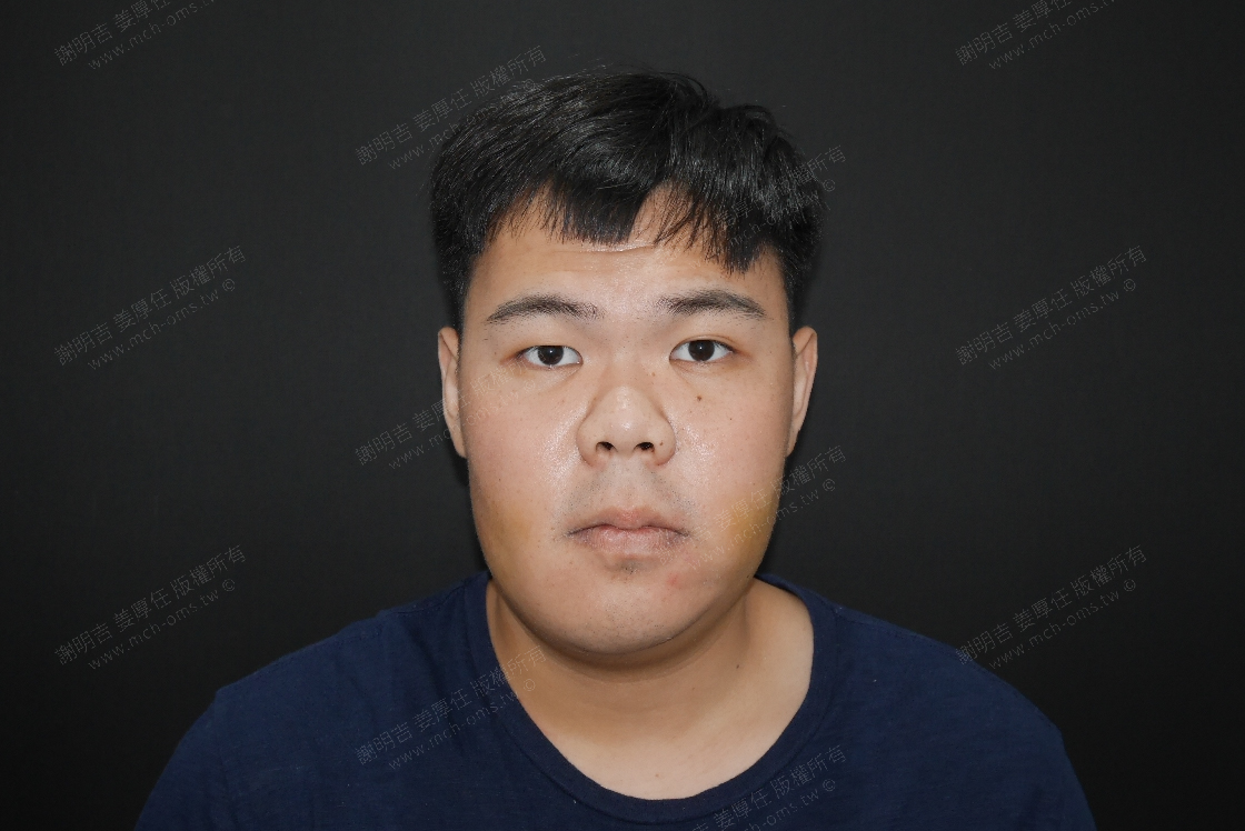 2019-05-25 3D customized orthognathic surgery photo 5