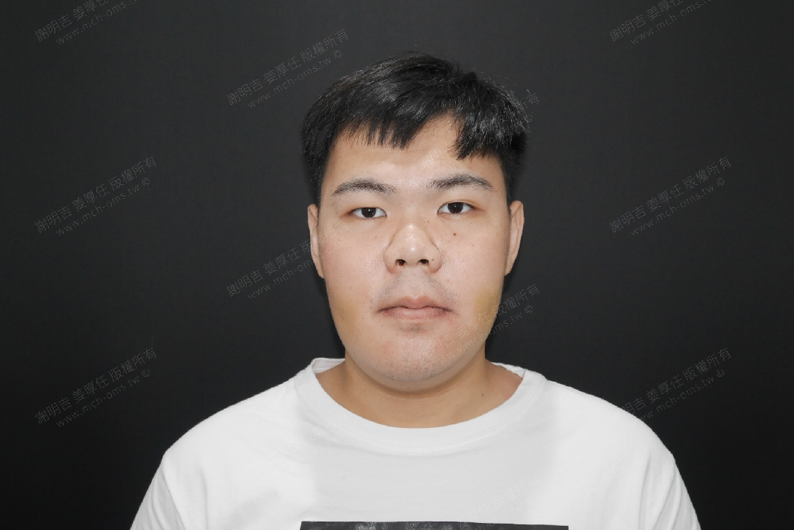 2019-05-25 3D customized orthognathic surgery photo 3