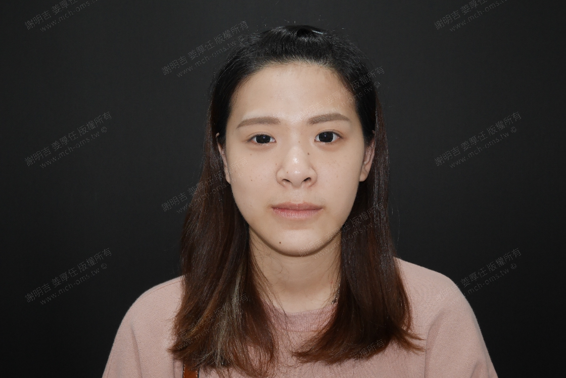 2019-05-18 3D客製化正顎手術 相關照片 1