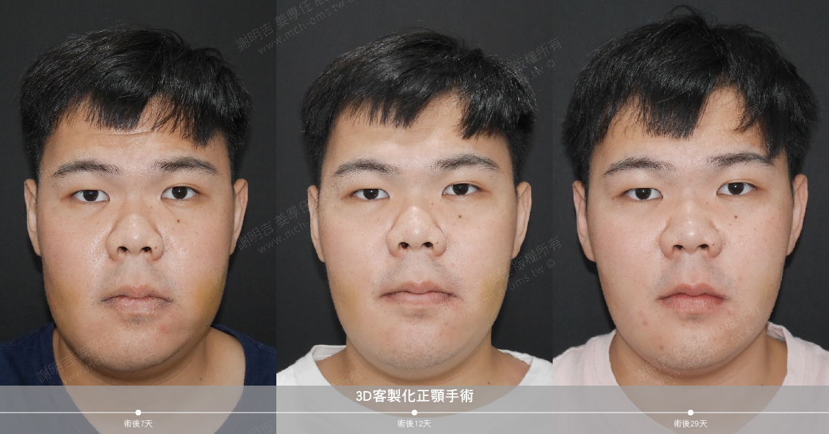 2019-05-25 3D customized orthognathic surgery