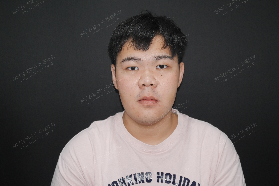 2019-05-25 3D customized orthognathic surgery photo 1