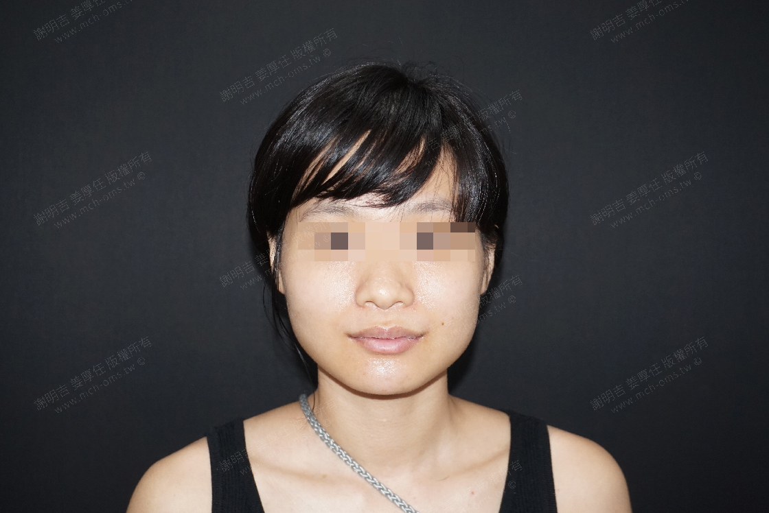 2019-06-15 Chin V-Line bone reduction surgery photo 3