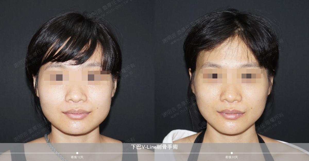 2019-06-15 Chin V-Line bone reduction surgery