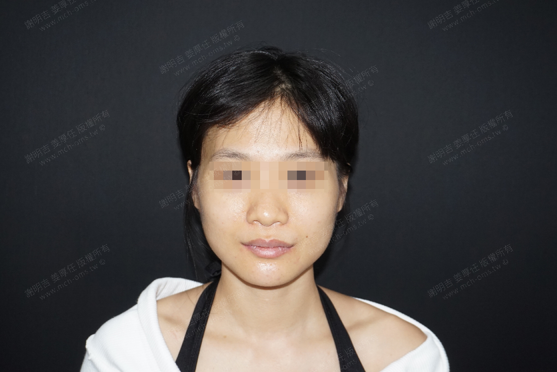 2019-06-15 Chin V-Line bone reduction surgery photo 1