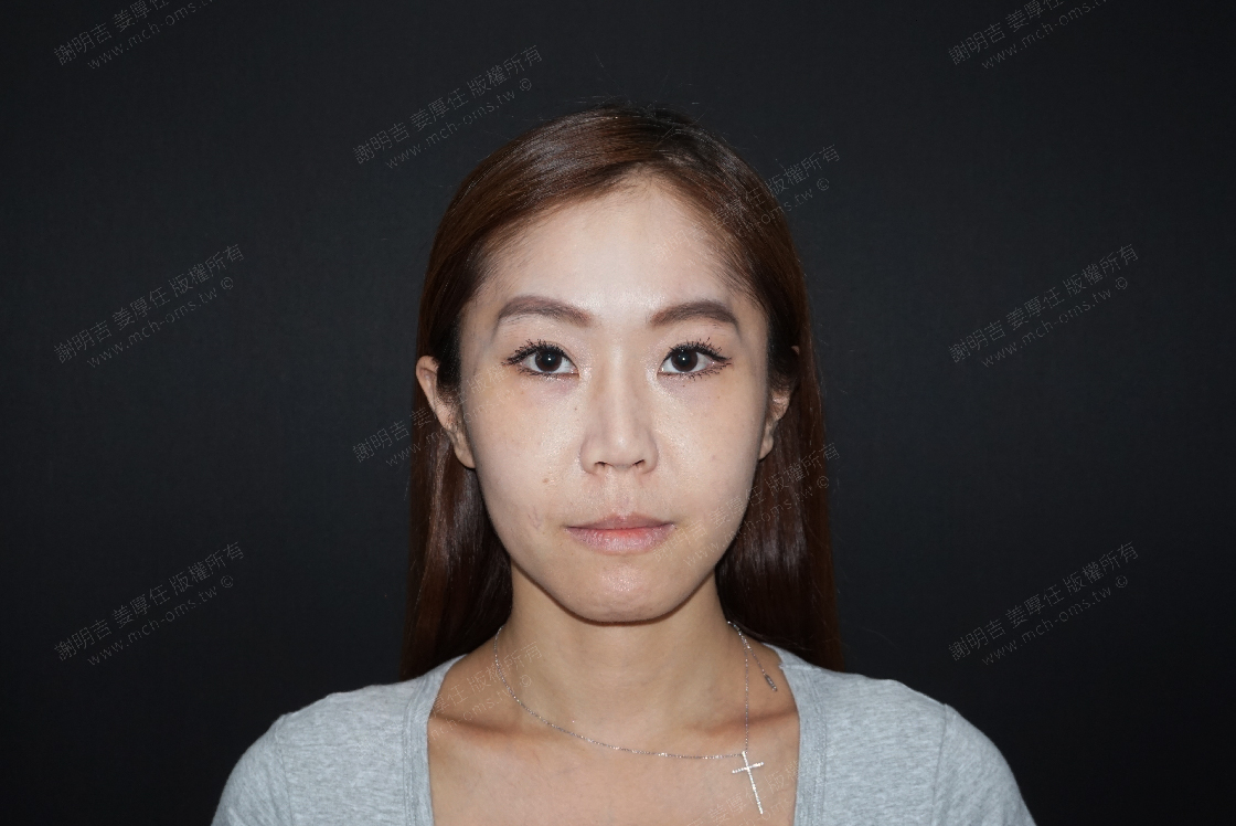 2019-06-22 拉皮手术+3D客制化正颚手术 相关照片 1