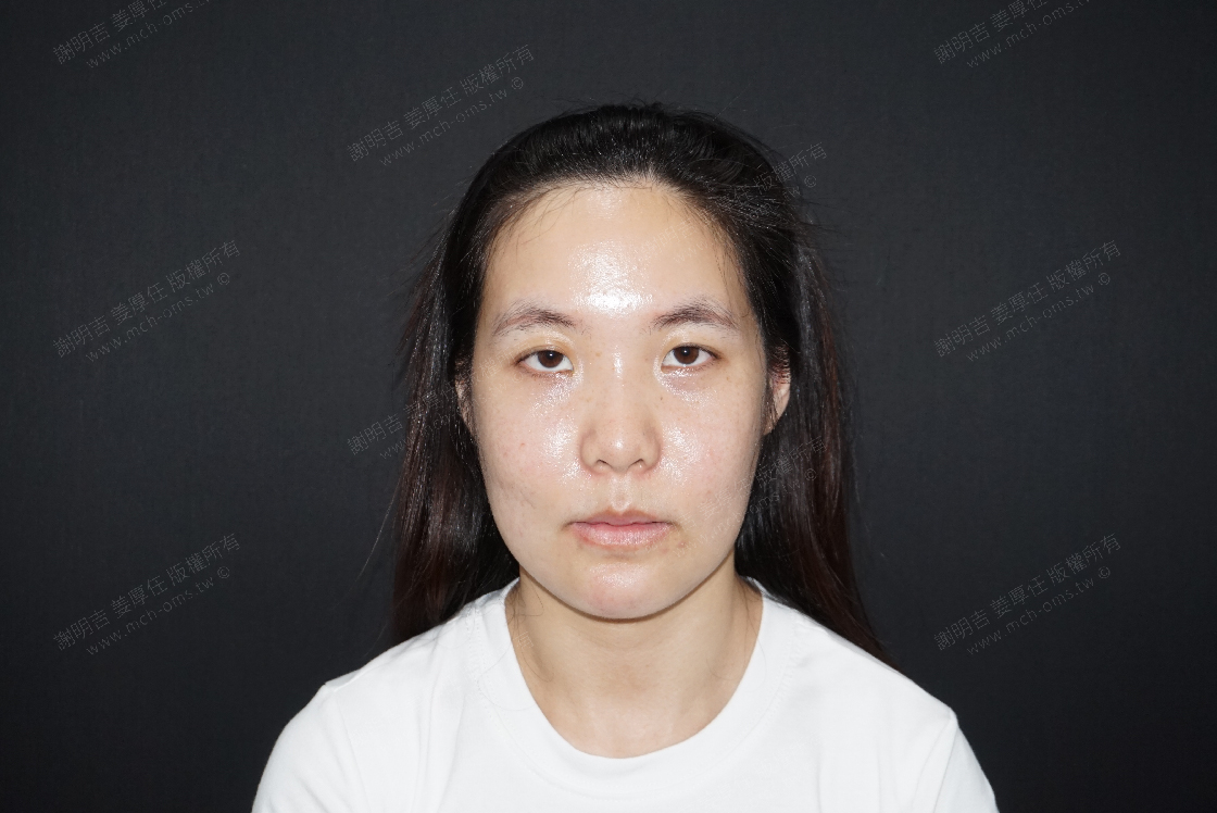 2019-07-13 3D客制化正颚手术 相关照片 1