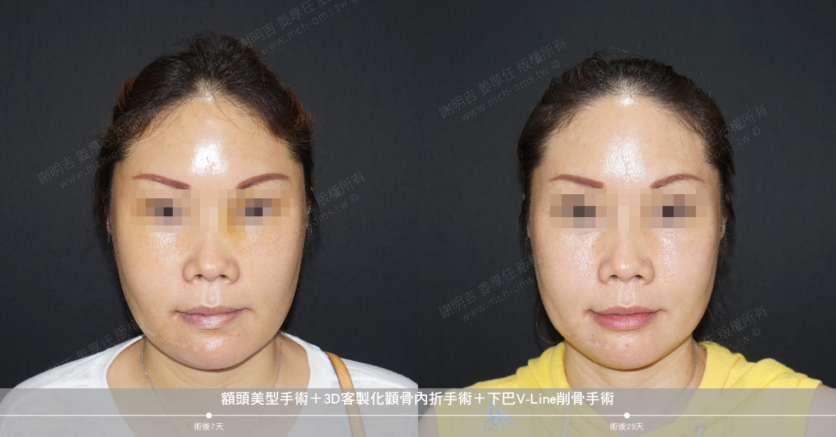 2019-07-13 額頭美型手術+3D客製化顴骨內折手術+下巴V-Line削骨手術