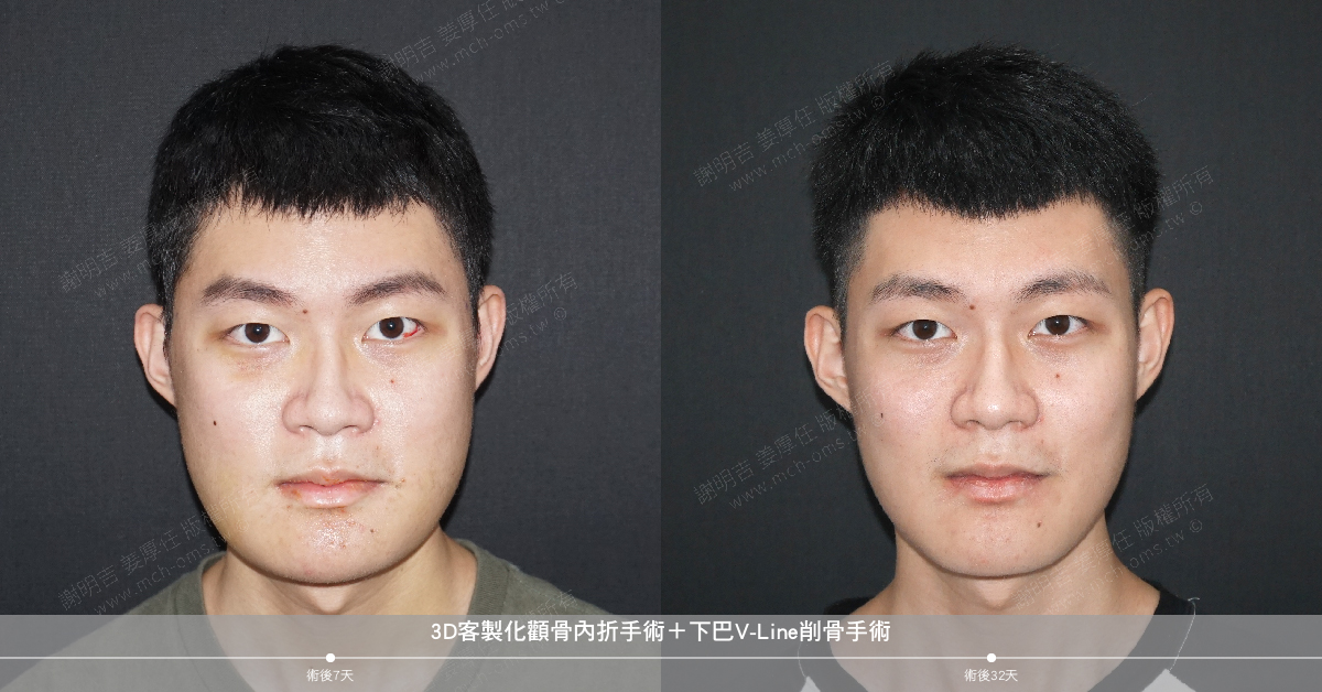 2019-09-07 3D客製化顴骨內折手術+下巴V-Line削骨手術