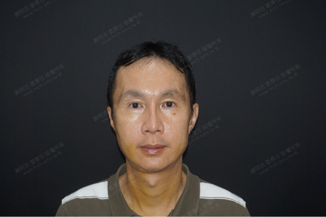 2019-10-26 3D Customized Zygomatic Inward Reduction Surgery + Chin V-Line Bone Reduction Surgery photo 3